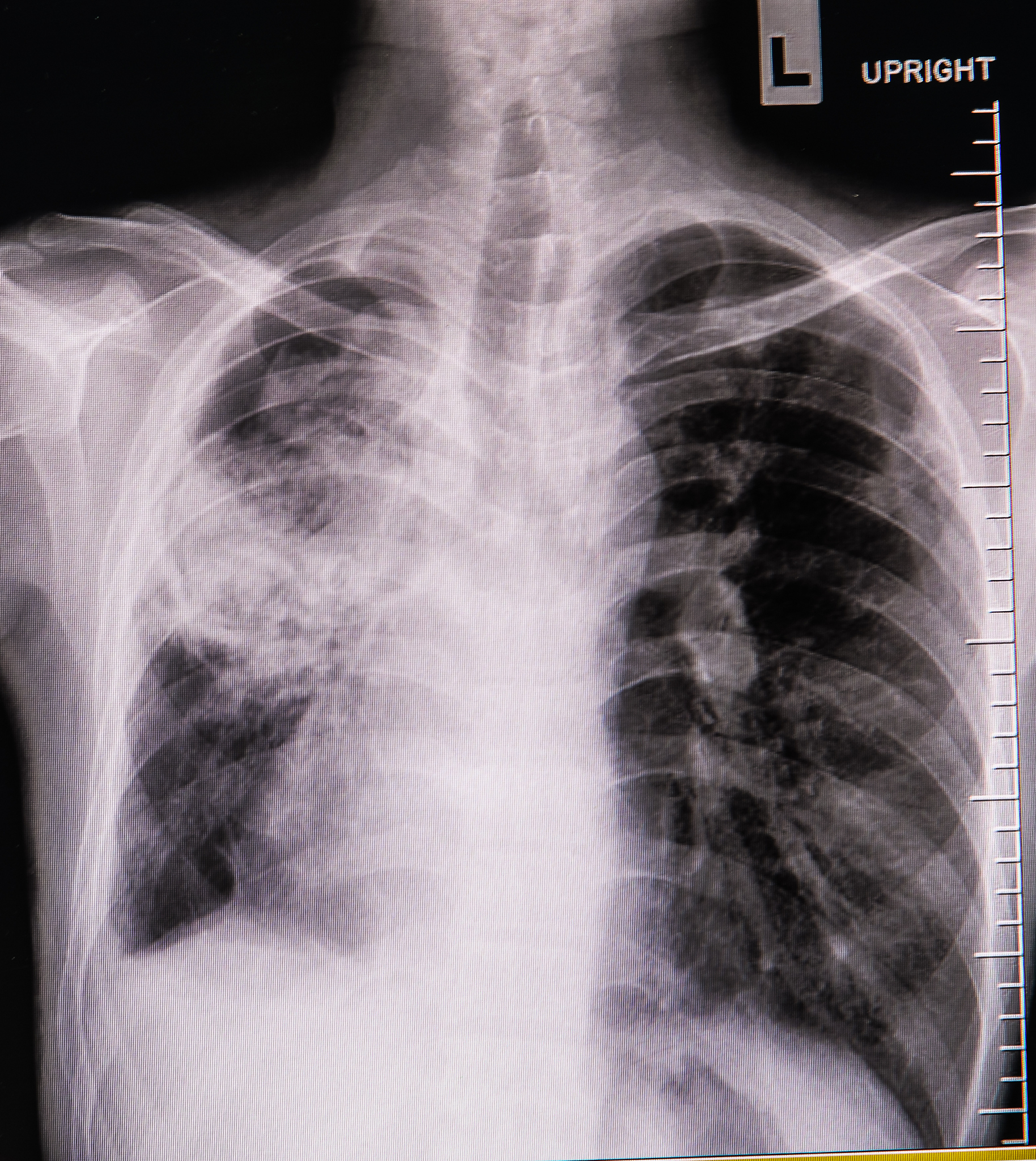 右肺腺癌术后呼吸衰竭伴肌肉脓肿感染护理指南
