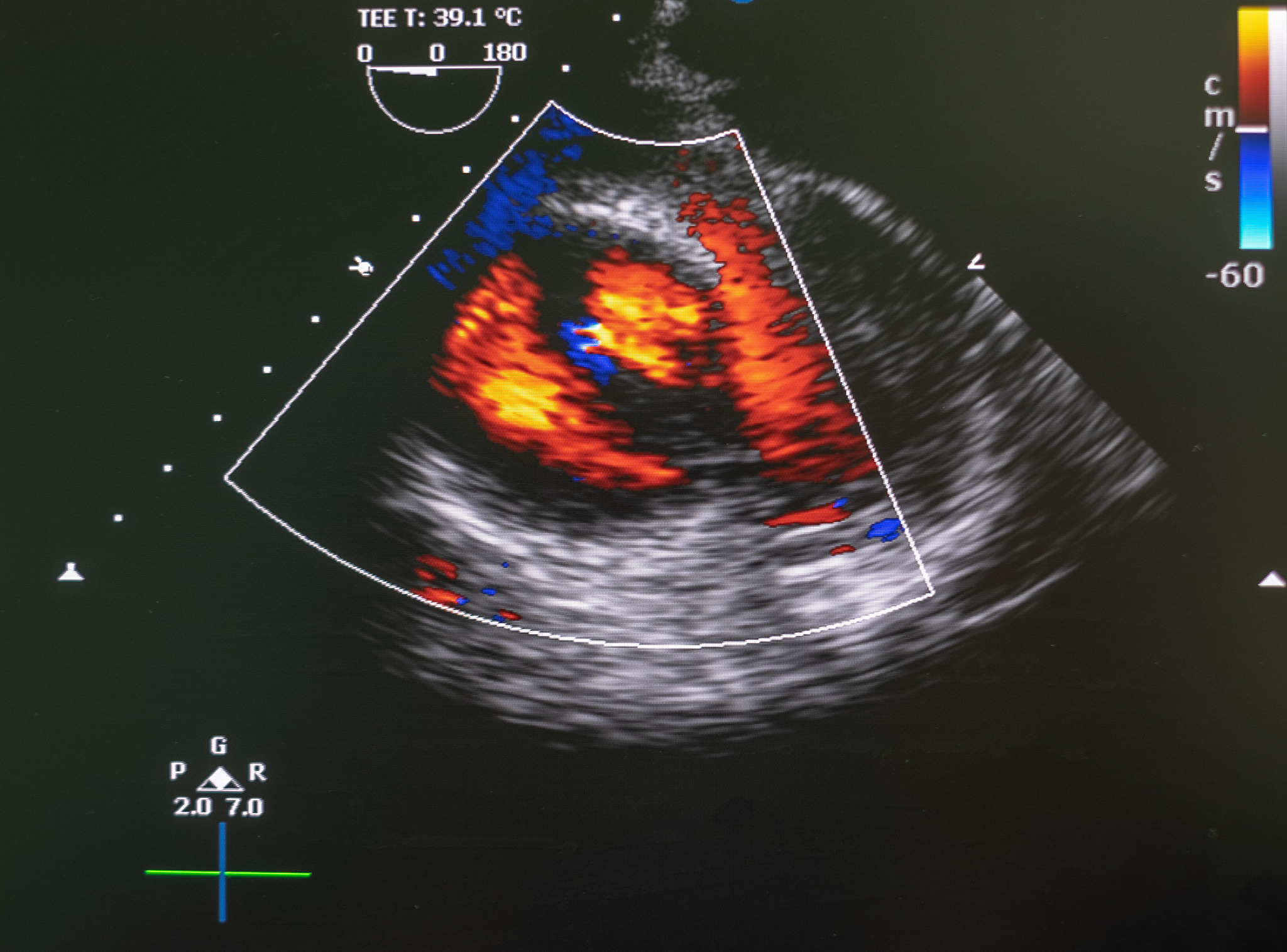 胆管腔内超声造影应用：提高诊断准确性