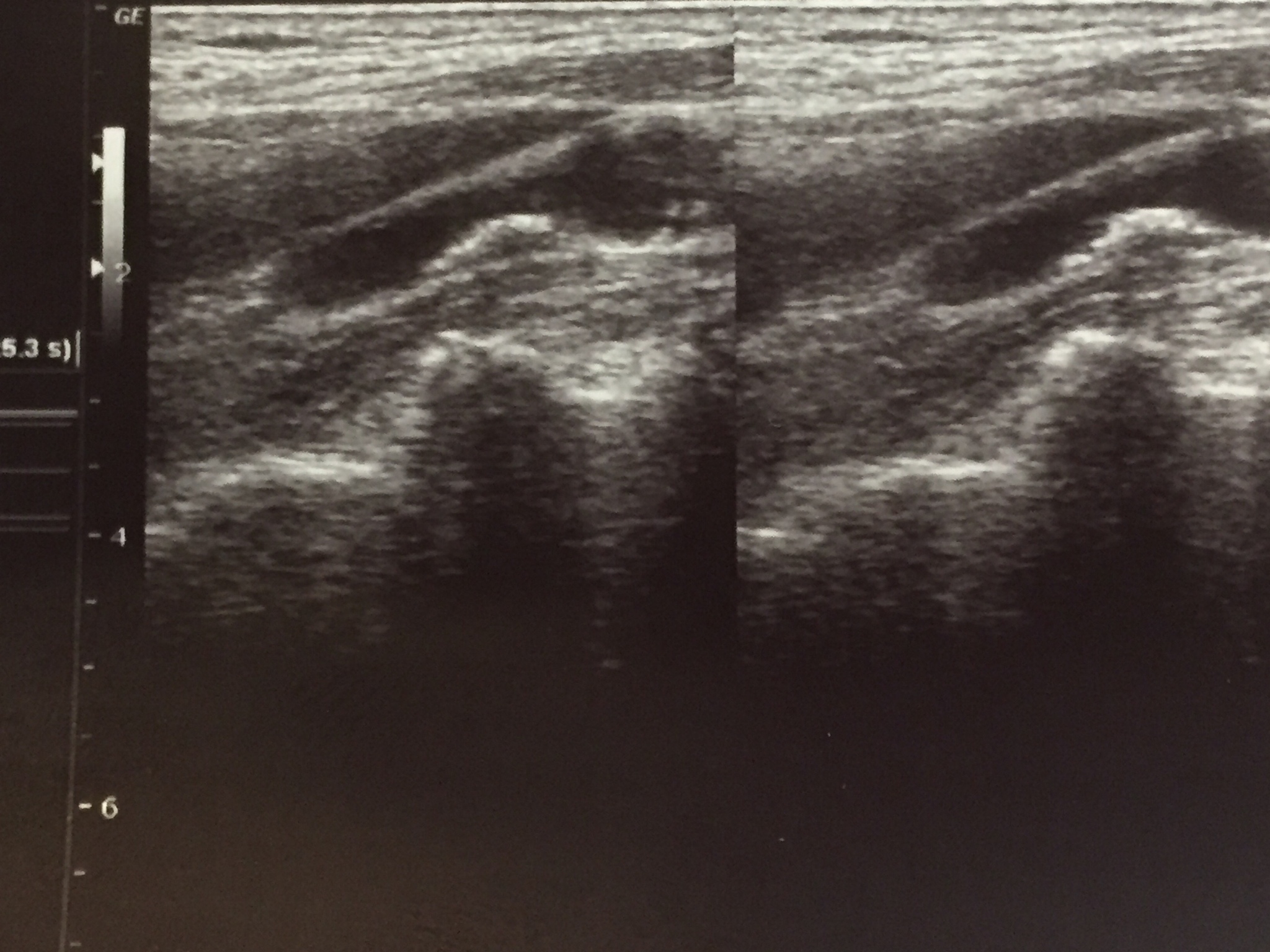 颈动脉搏动与斑块远端运动的潜在联系 颈动脉搏动与斑块远端运动的潜在联系