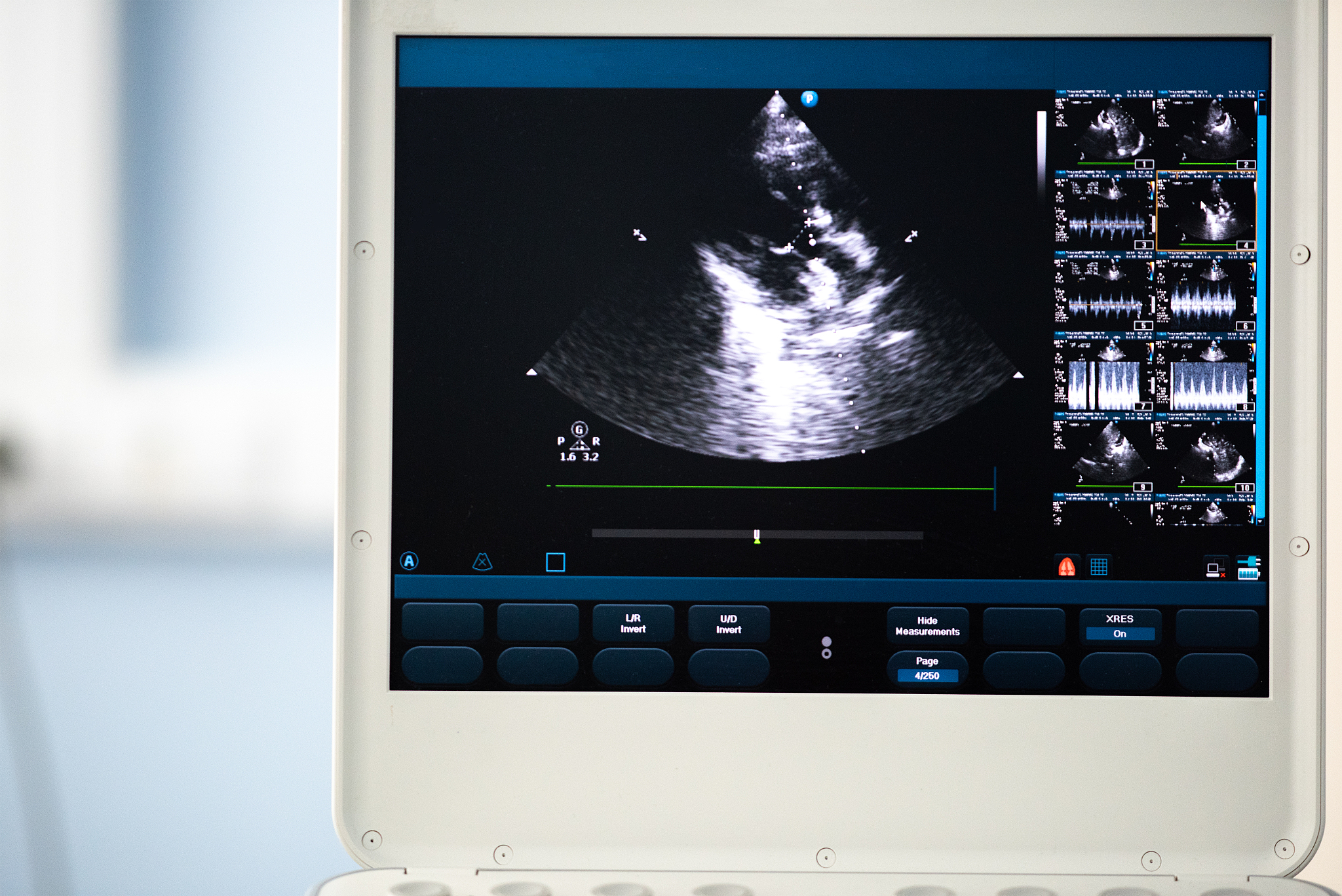 心腔内超声检查步骤：从准备到解读，详细指南