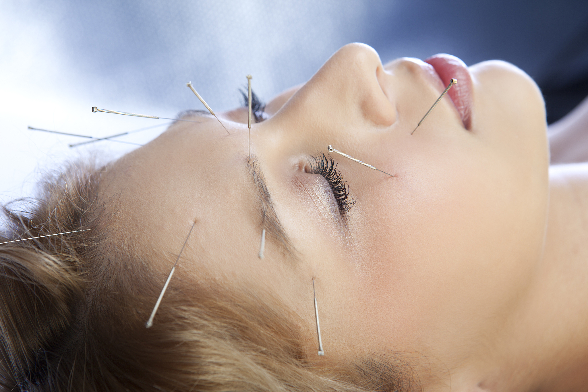 acupuncture treatment