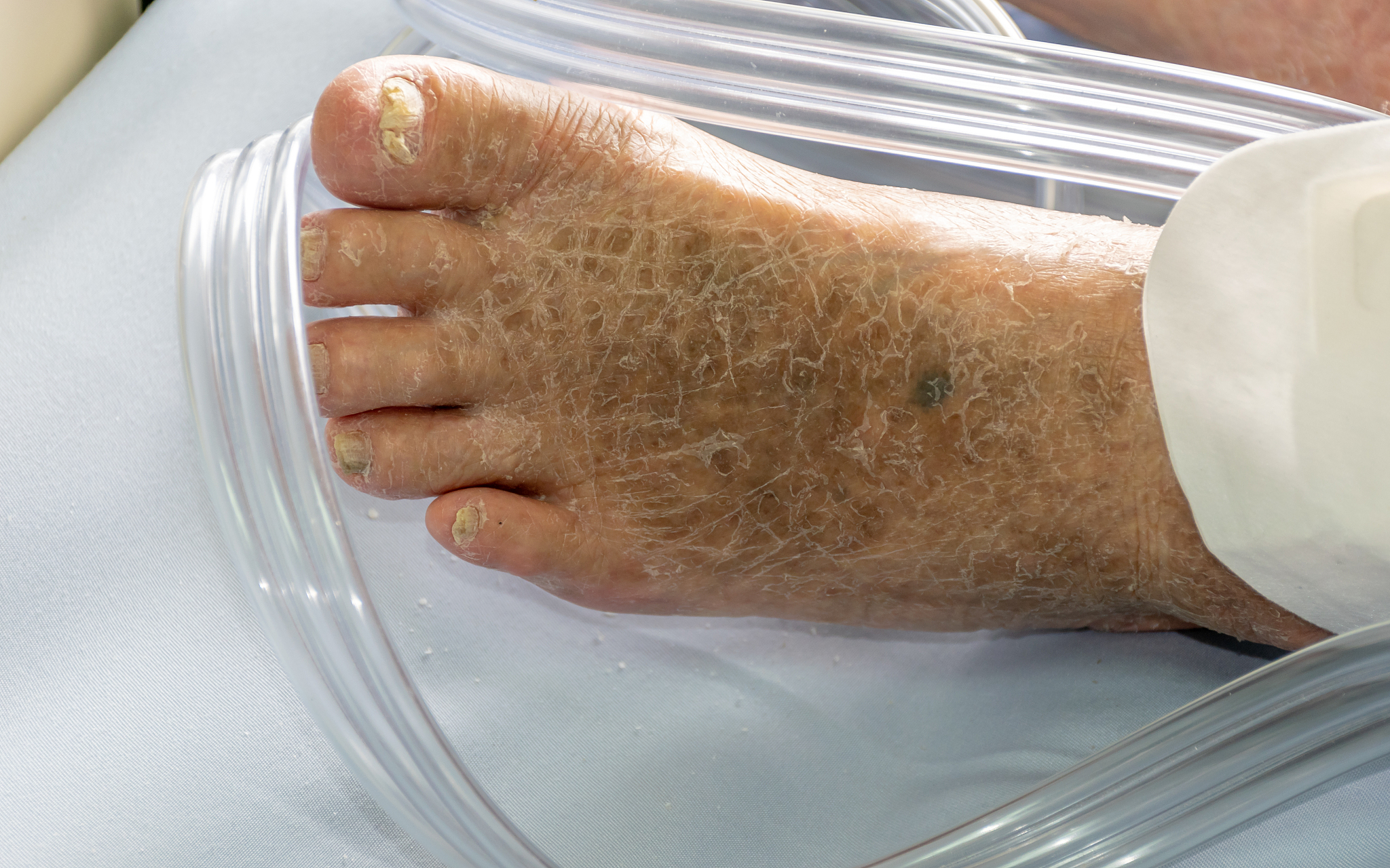 老茧对身体有影响吗