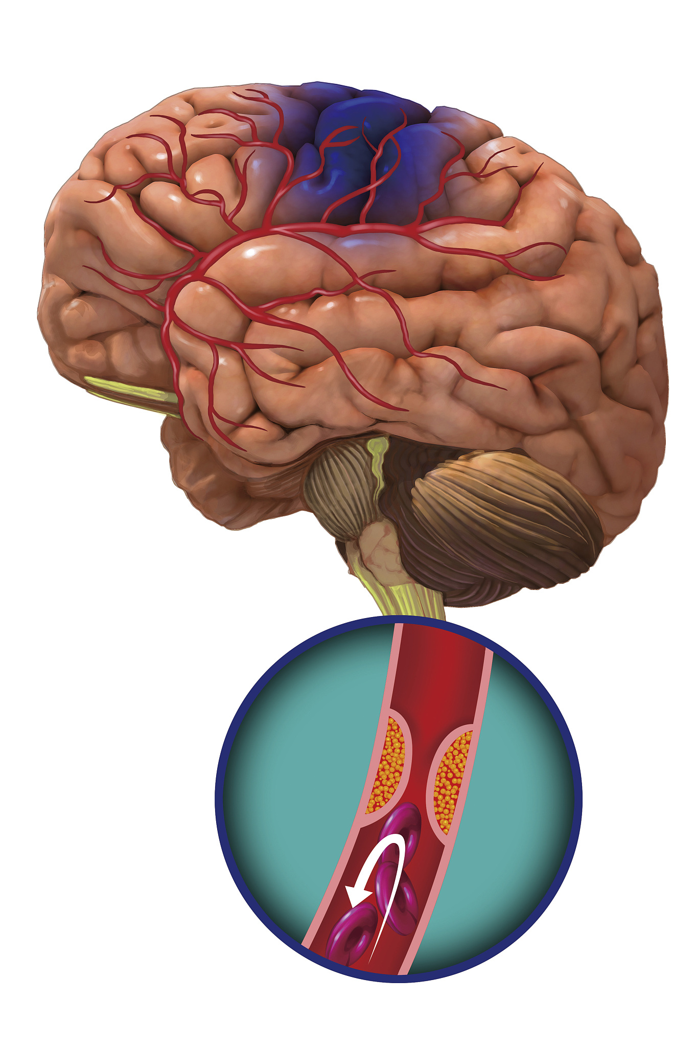 脑出血的定义的PPT