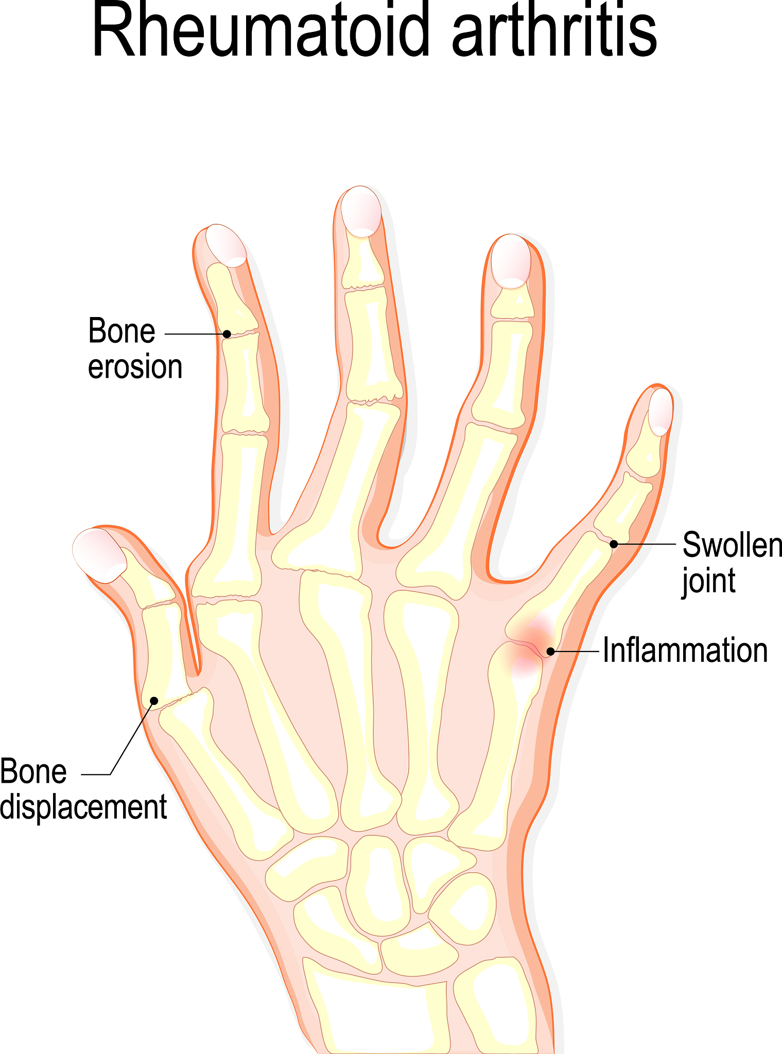 Pinky MCP 关节：人体骨骼解剖与常见问题