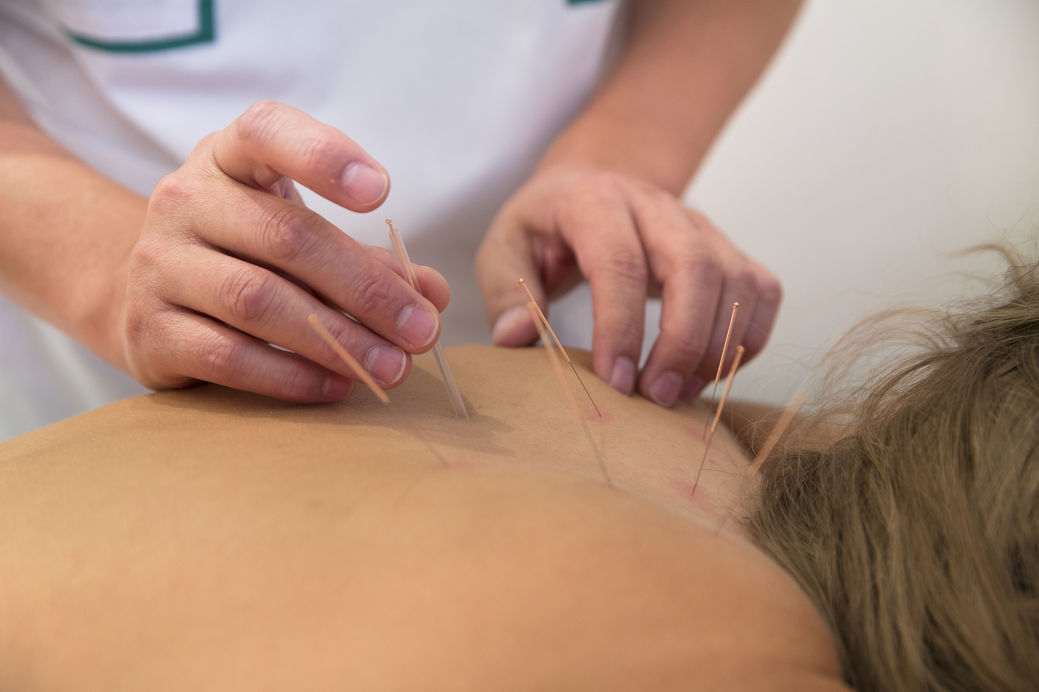 treatment by acupuncture