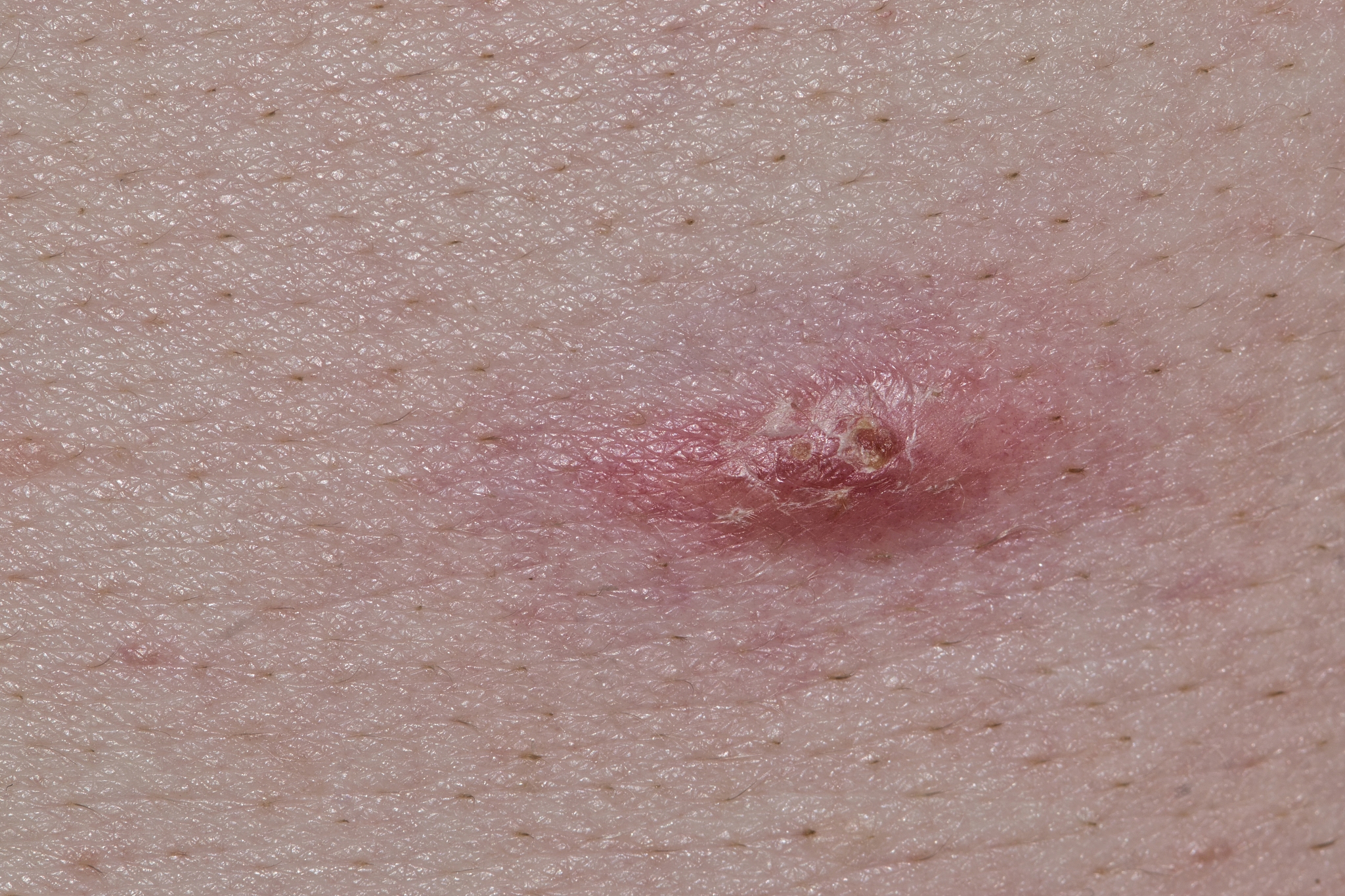 acne pimple on caucasian skin.