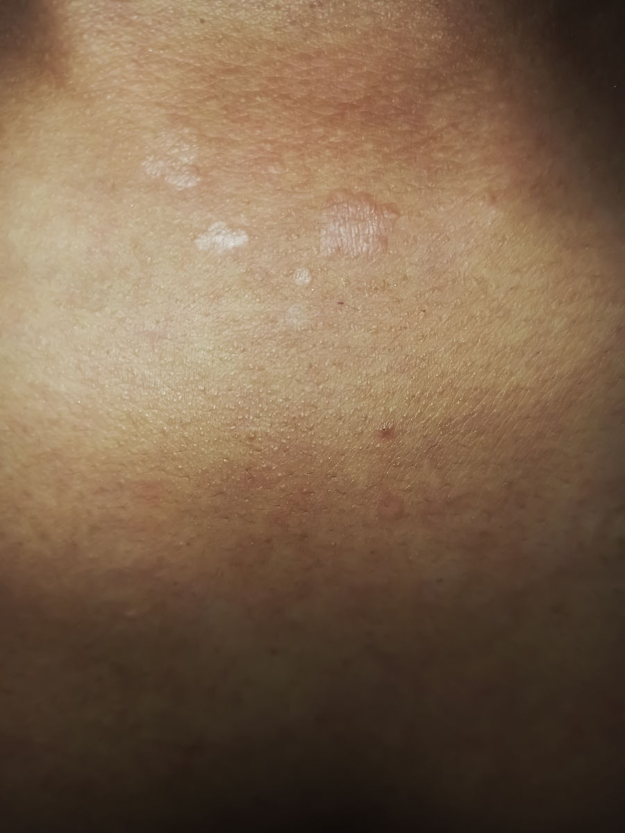 毛囊炎是艾滋病的早期症状吗？别担心，两者没有关系