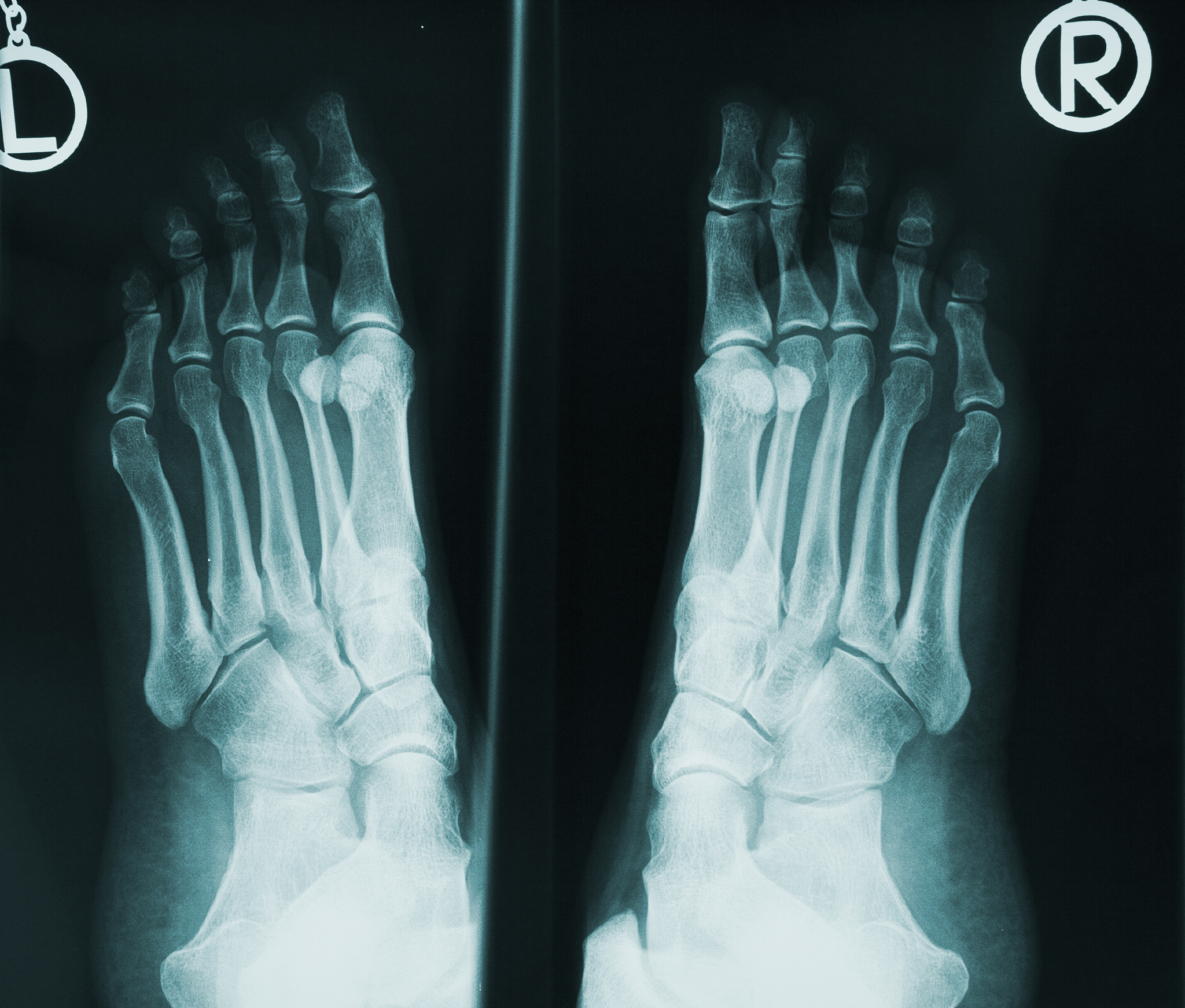 第五趾骨基底骨折，做了手术之后需要多久能脱拐走路