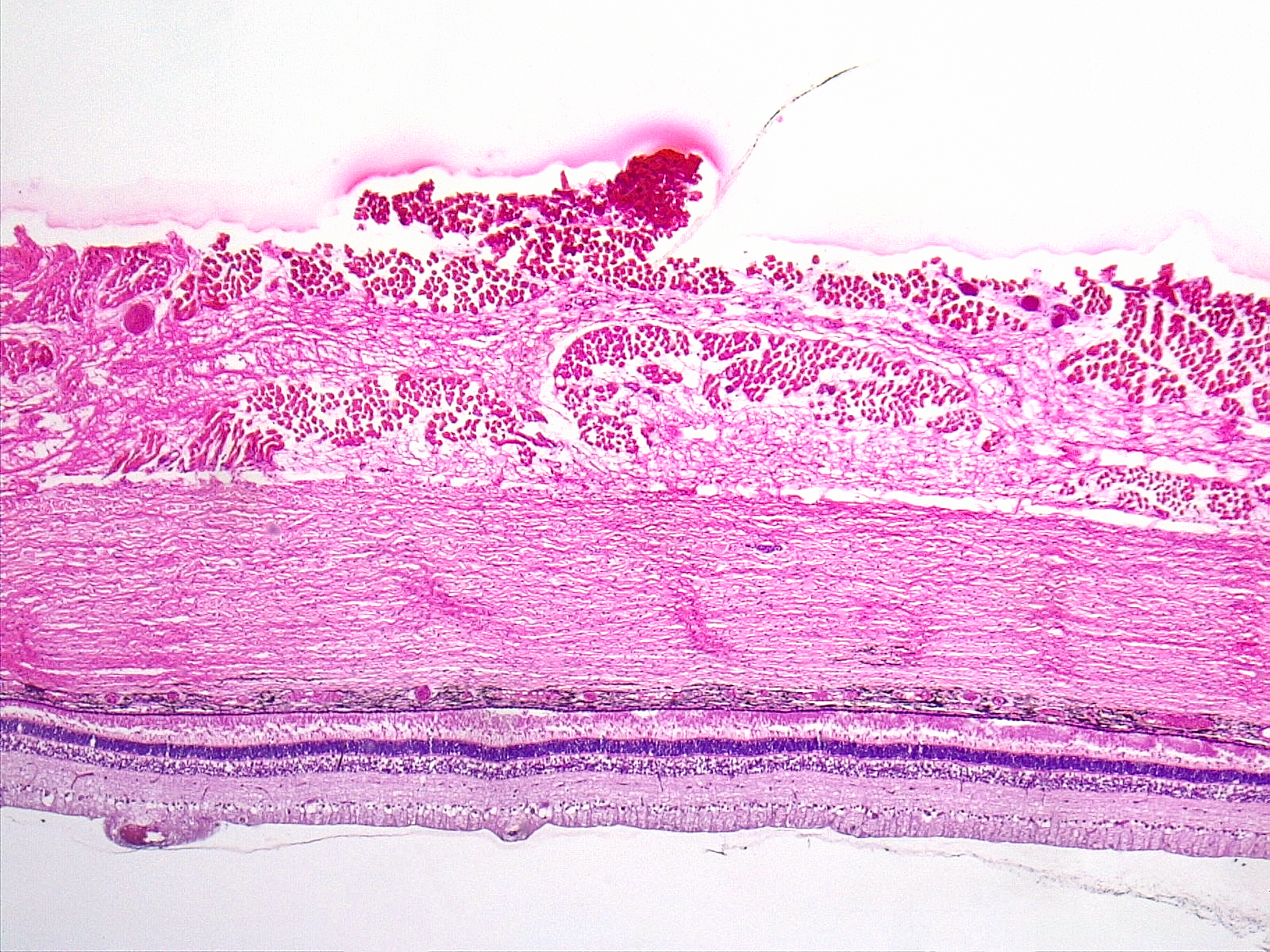 翻译：This article discusses the prognostic value of lymphovascular invasion LVI and perineural invasion PNI in stage III colon cancer The study found that LVI and PNI are important pathological factors