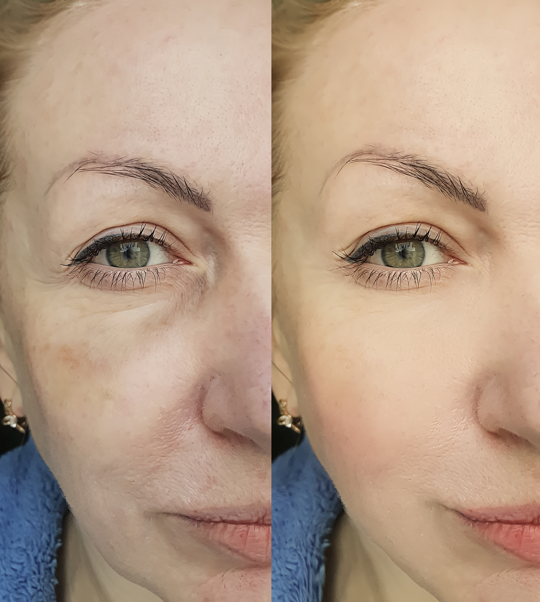 眼袋形成原因及治疗方法：有效改善眼部松弛和肿胀