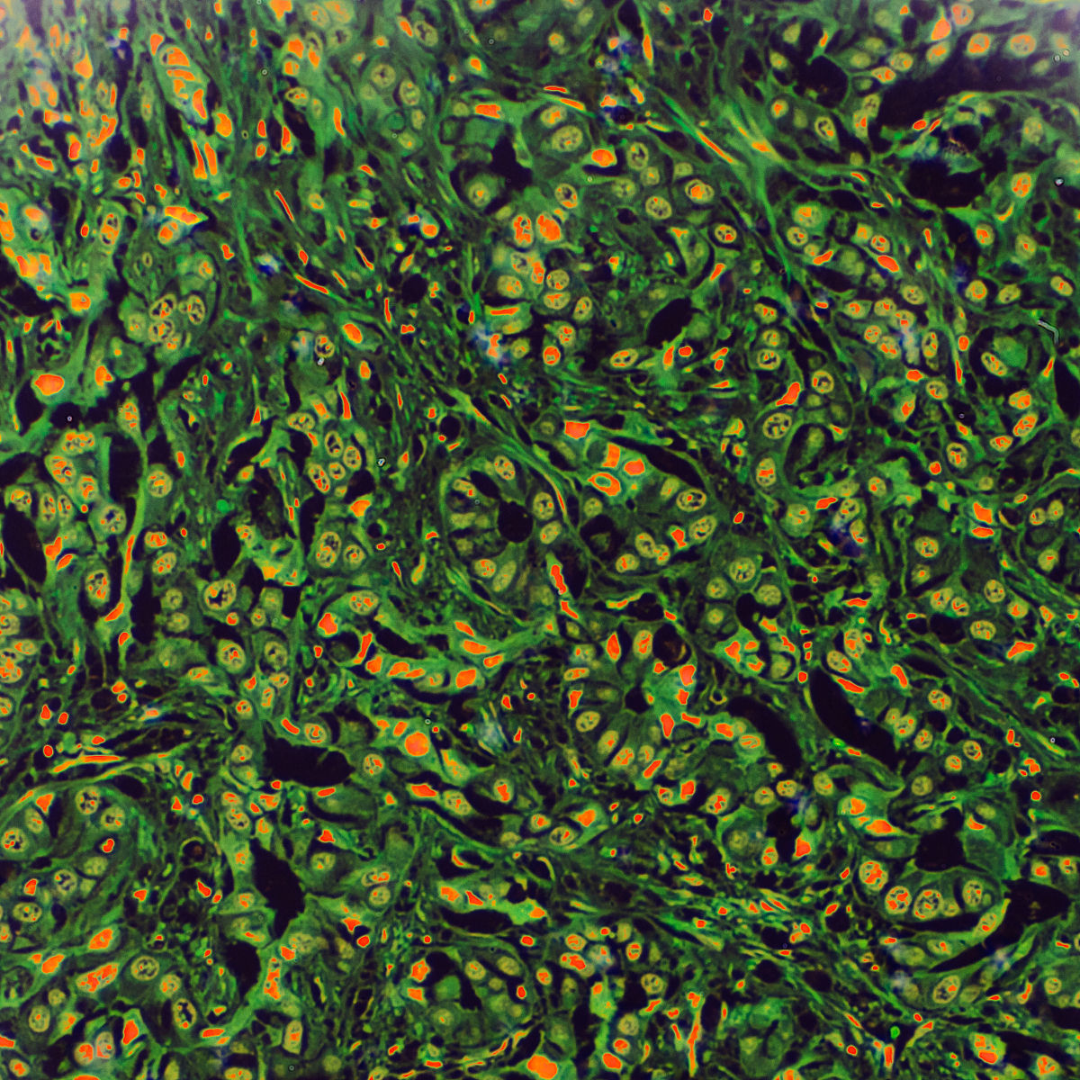 t-SNE分析揭示APs活性可区分肝癌与正常肝组织