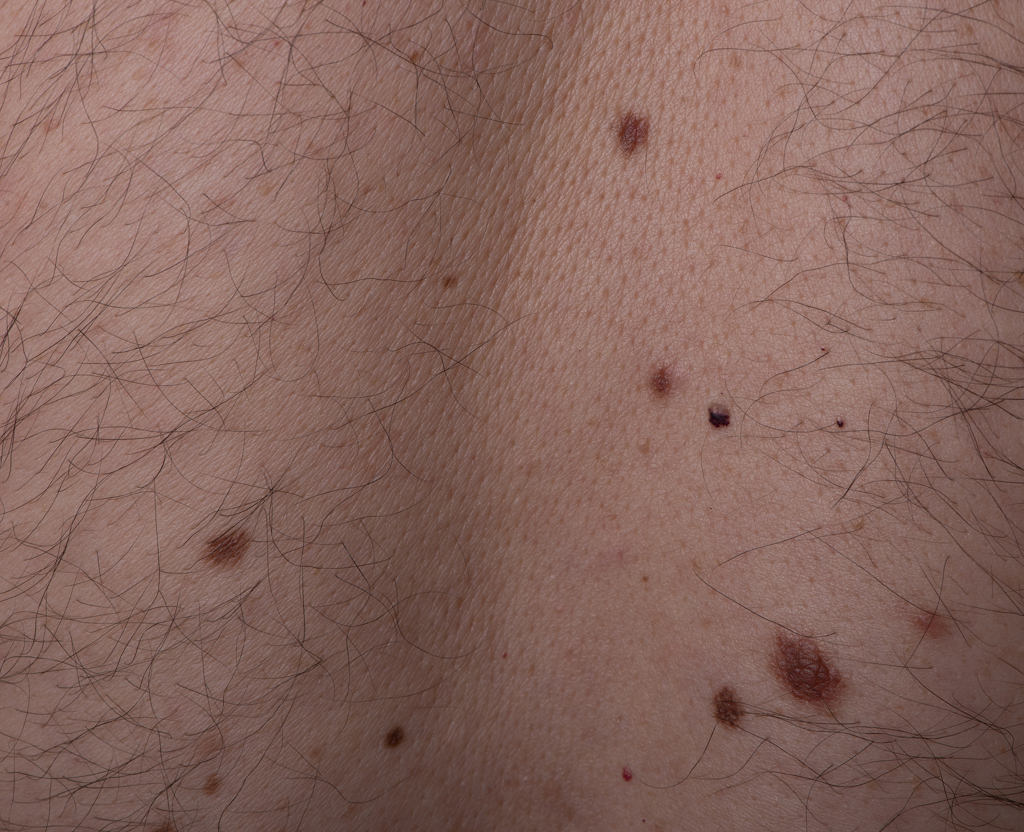 背部有痣真的会穷一生吗？揭秘真相！