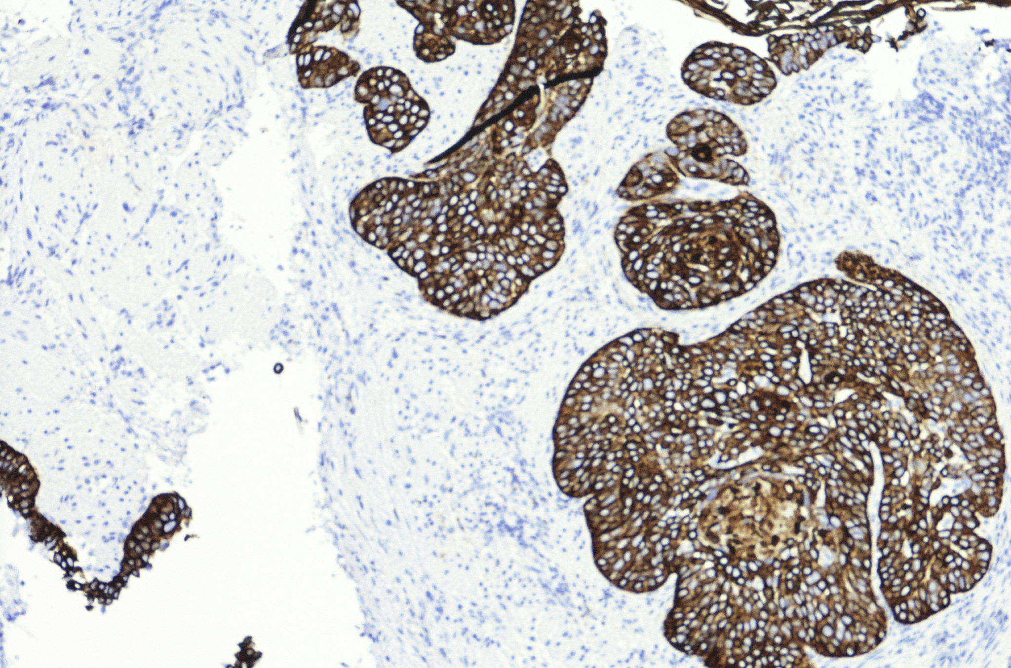 食管癌：症状、治疗和预防 - 全面指南