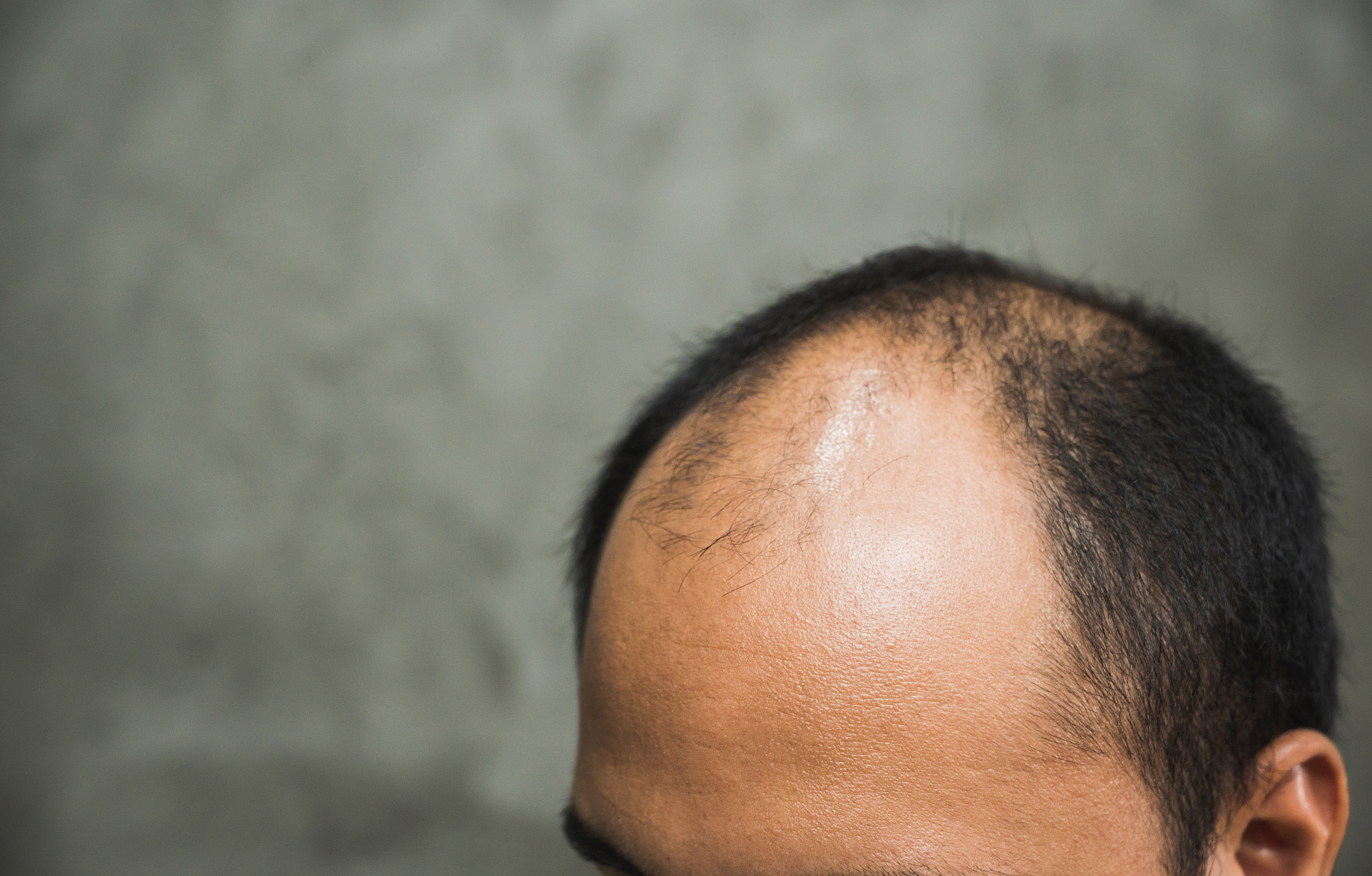 发际线高怎么办？5种方法帮你找回自信！