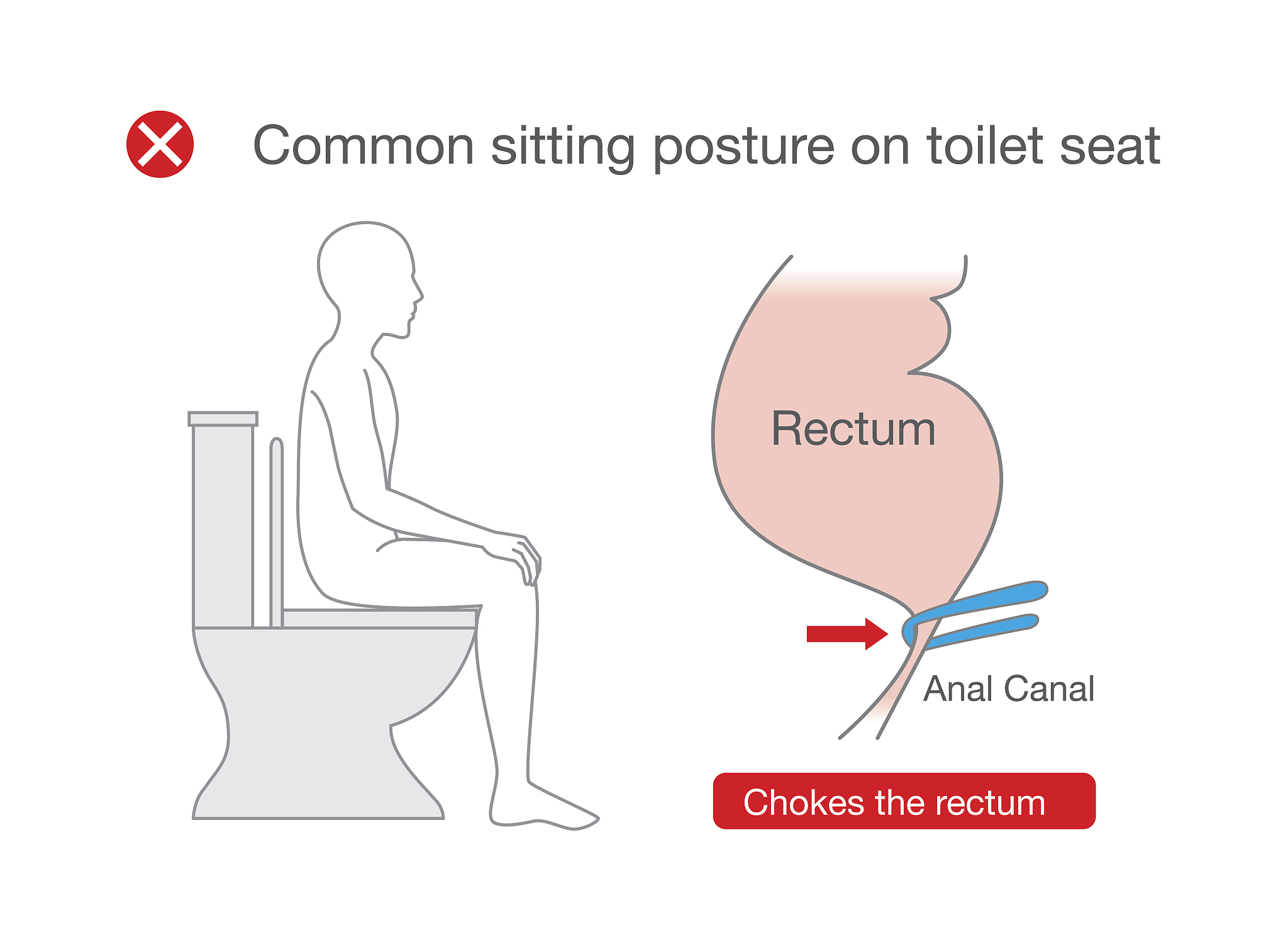 common posture while sitting on toilet make rectum discomfort.