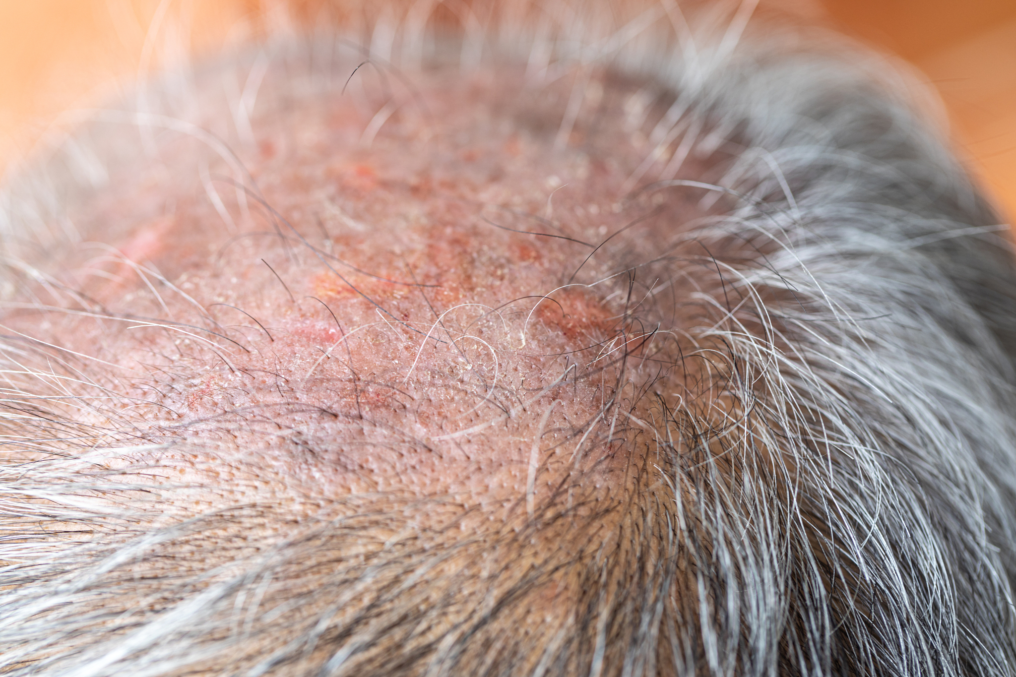 毛囊炎反复发作怎么办？试试这些方法！