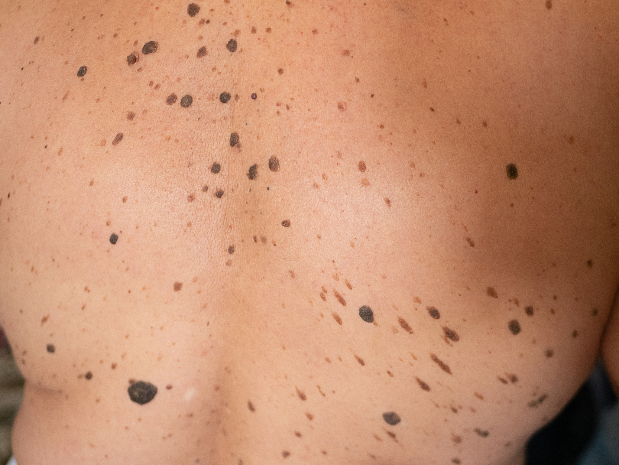 human low and middle back with lot of brown nevi.
