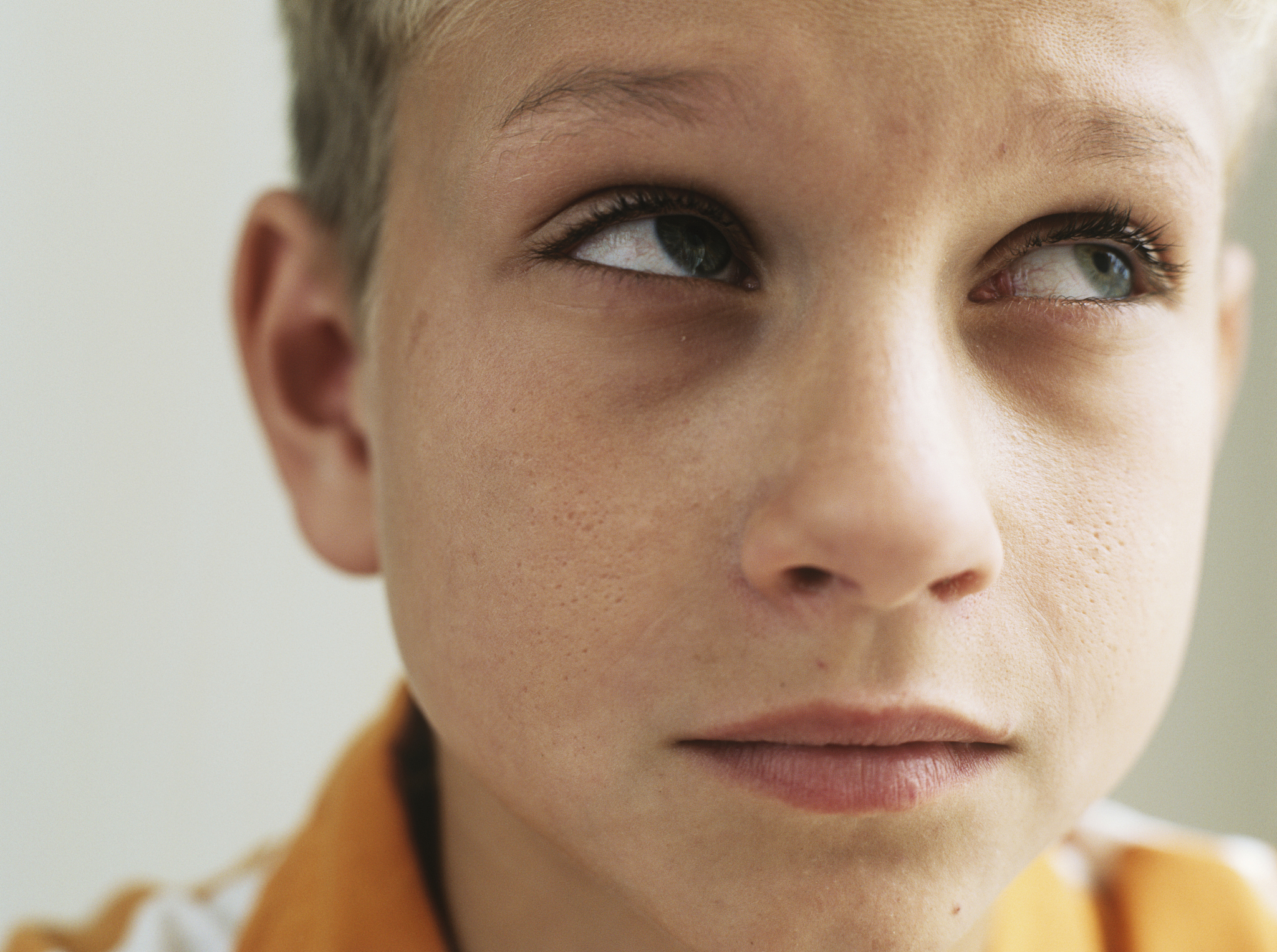 白人脸上为什么会长斑，