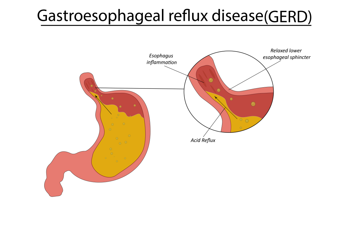 粘连性肠梗阻水电解质平衡维持的重要性