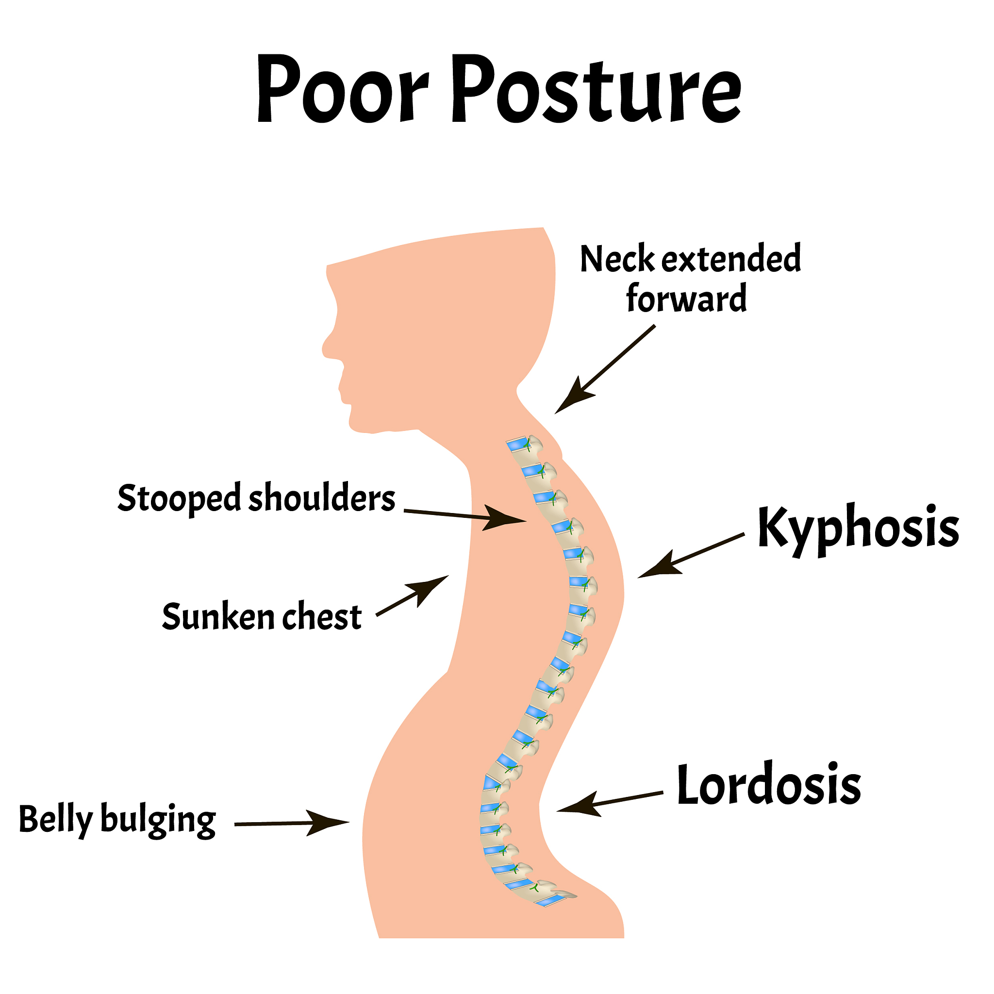 I like to sleep on my side However because one shoulder has a certain width my spine is not straight in the anatomical coronal plane when I sleep on my side as it is when I am standing but bends a lit