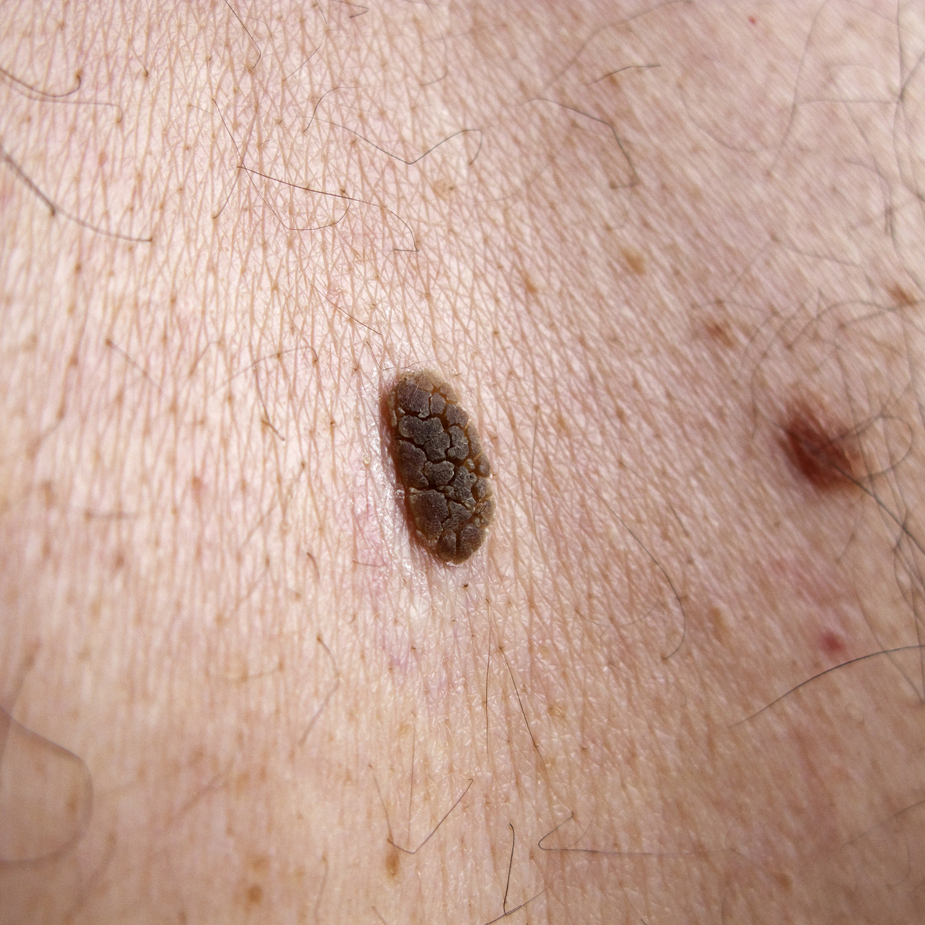 seborrhoeic keratosis