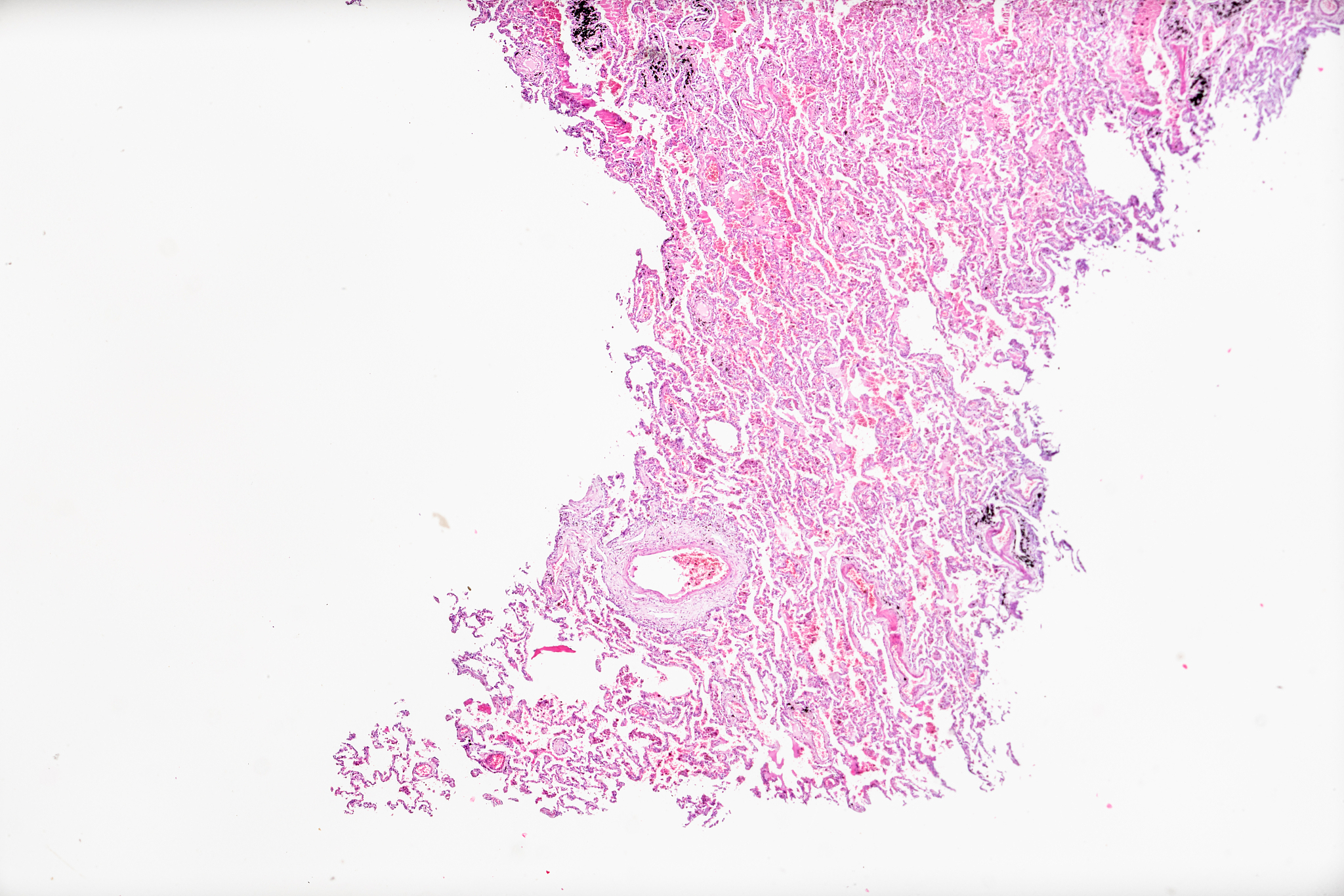 患者大叶性肺炎首选考虑药物