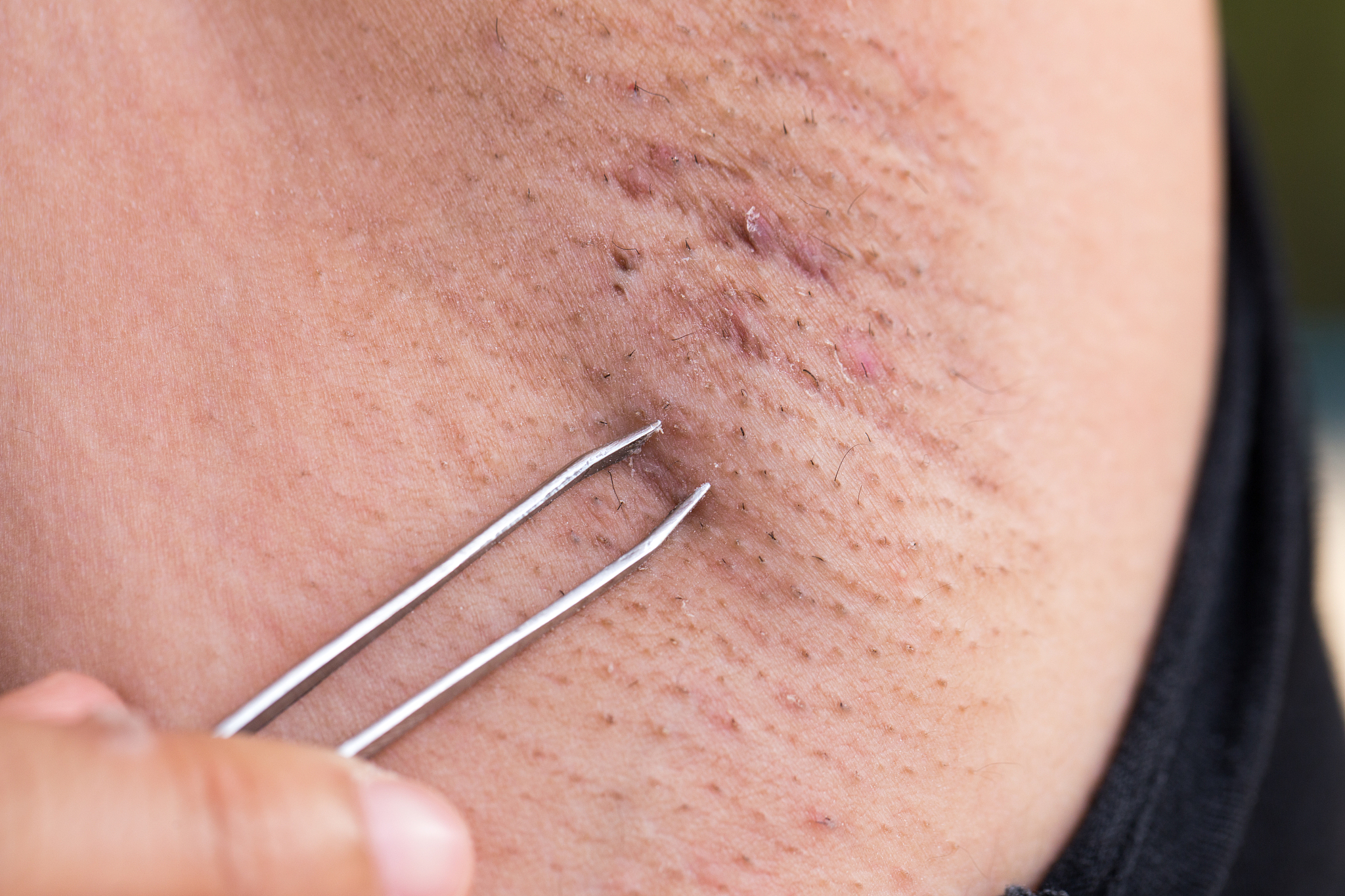 有效去除黑头小妙招，告别草莓鼻！