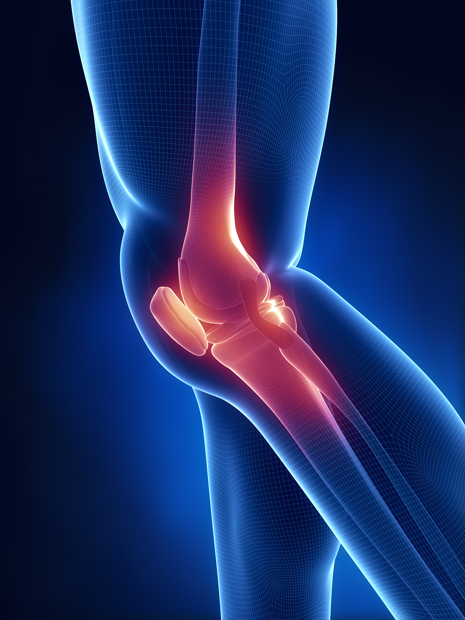 膝关节骨关节炎：症状、原因、治疗和预防