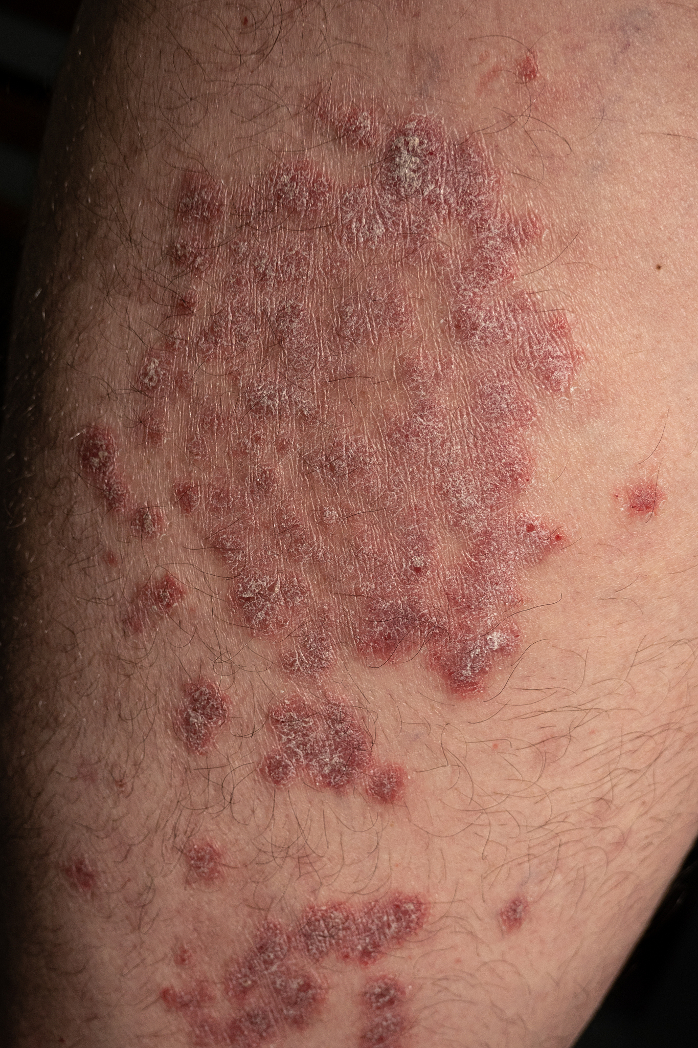 psoriasis is a chronic, inflammatory autoinmune skin disease