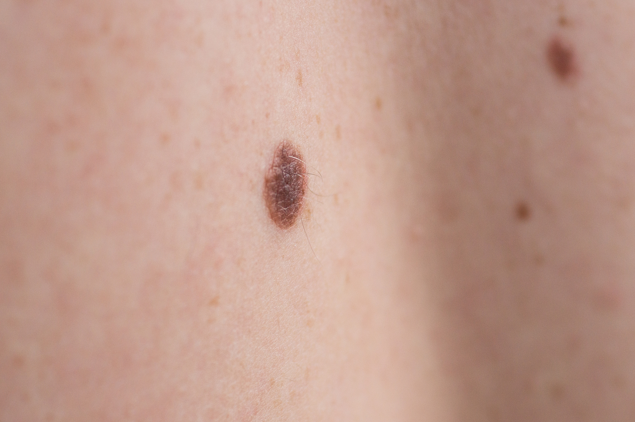 checking benign moles. close up detail of the bare skin on a man