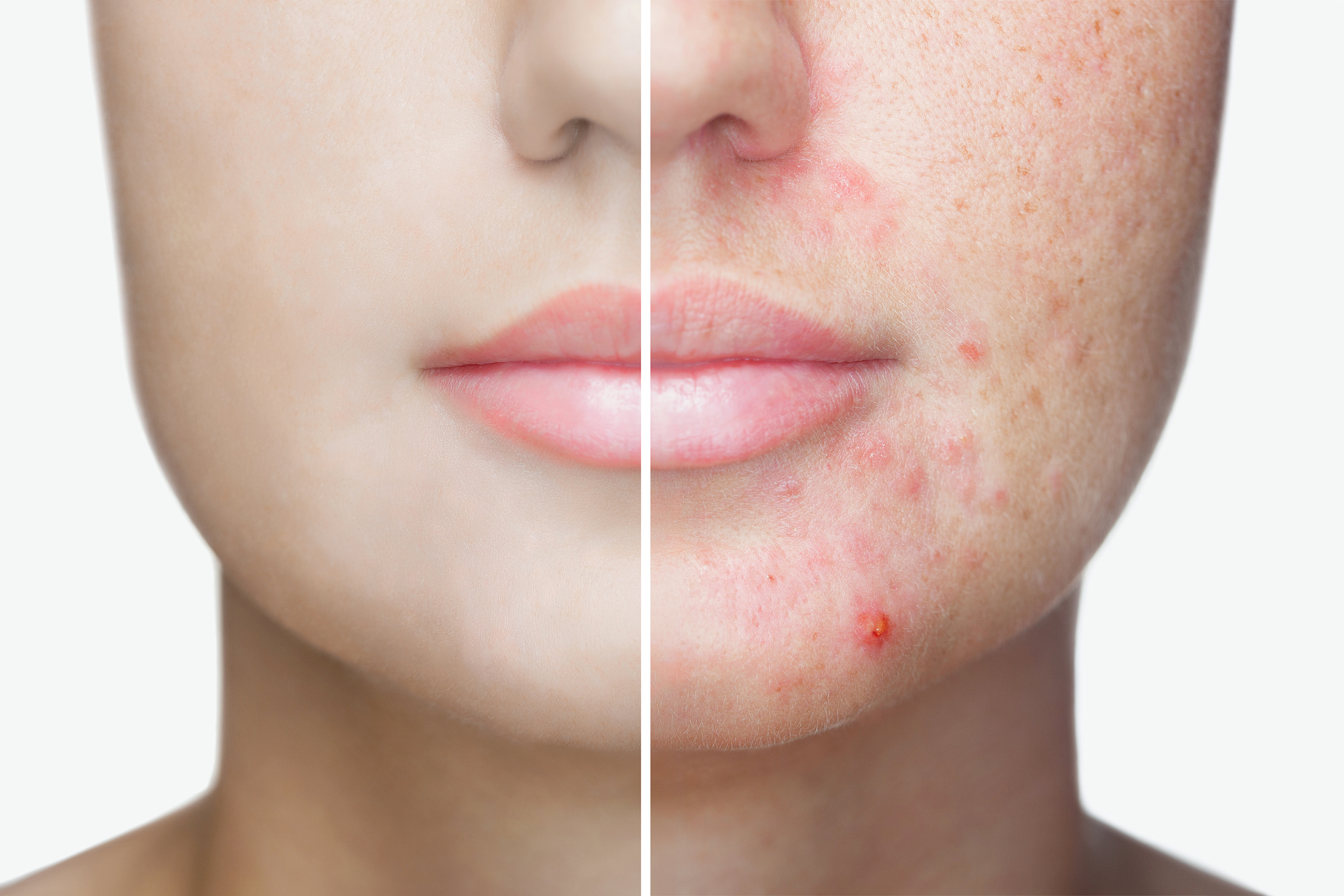 a young girl with a problem skin. photo before and after treatme