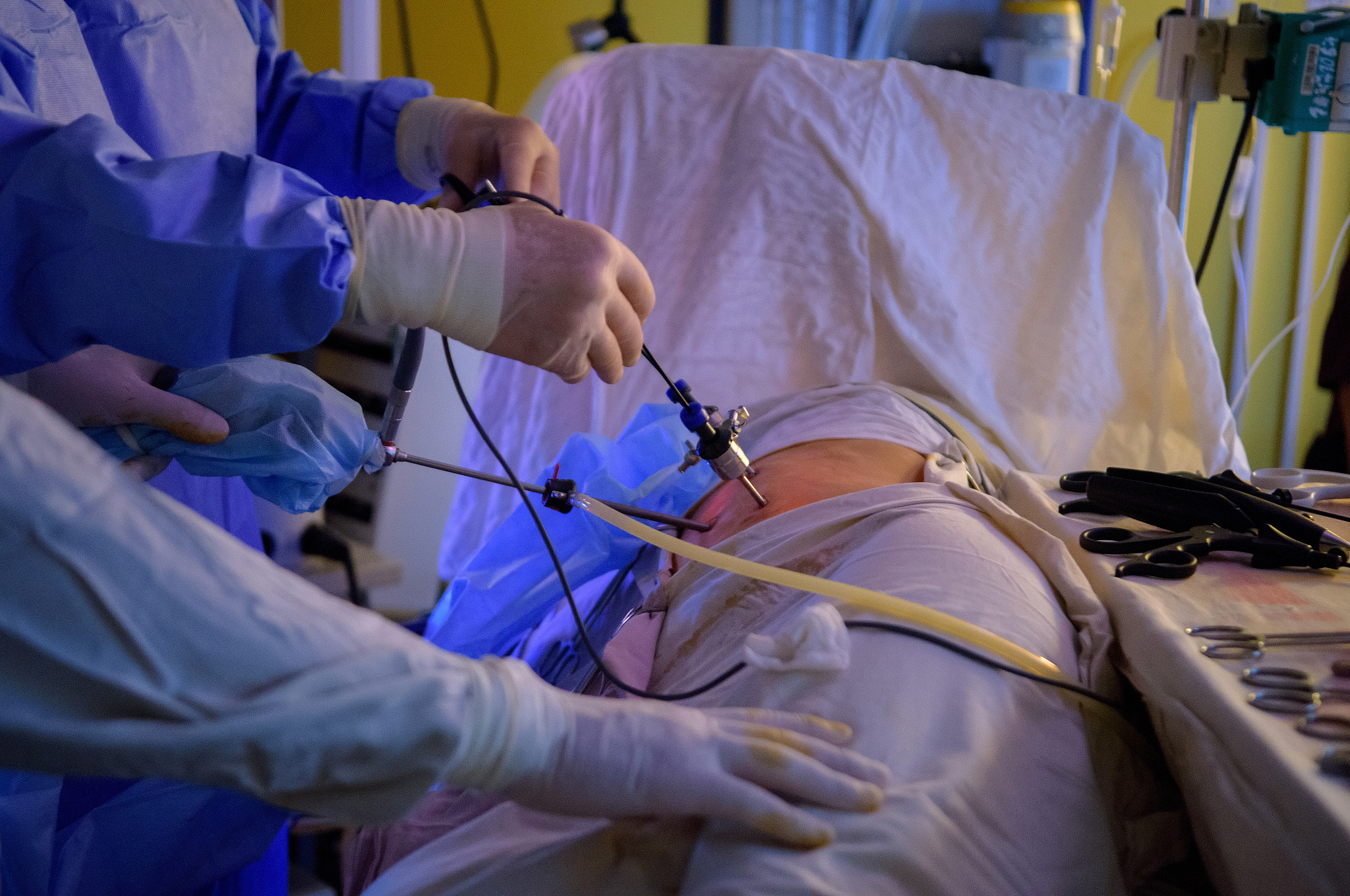laparoscopic surgery operation