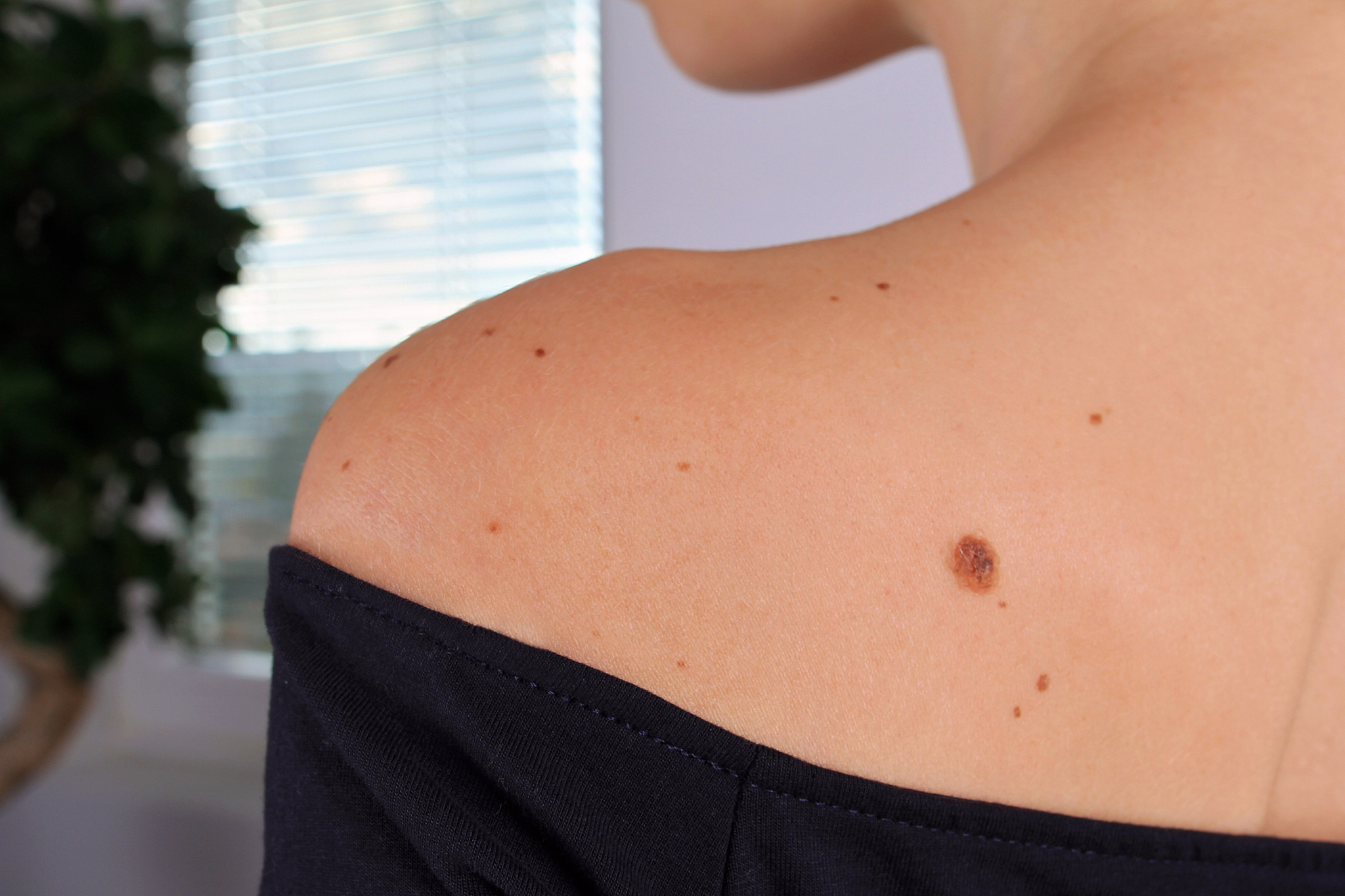woman with birthmarks on her skin.skin tags removal.