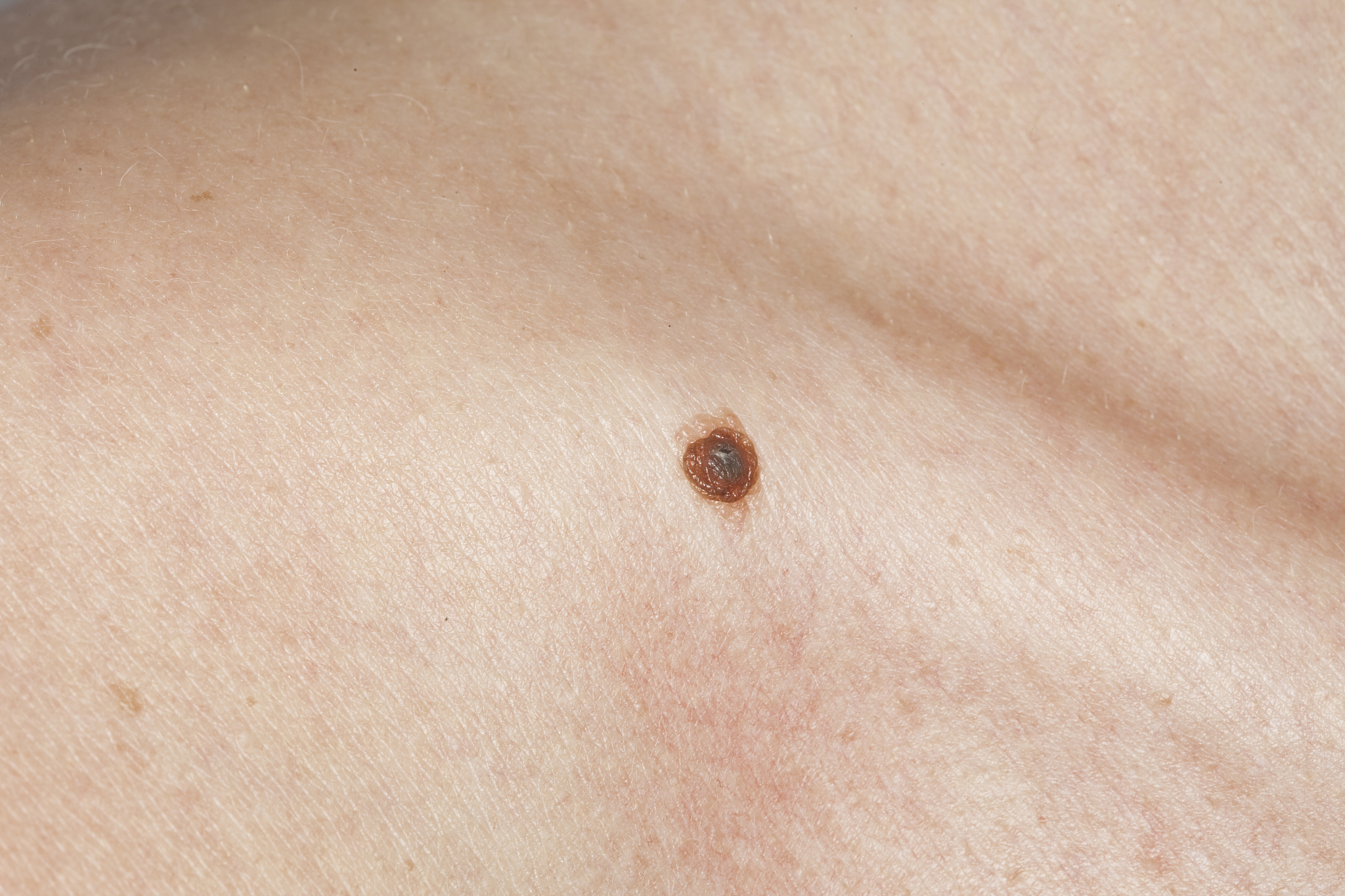 skin cancer