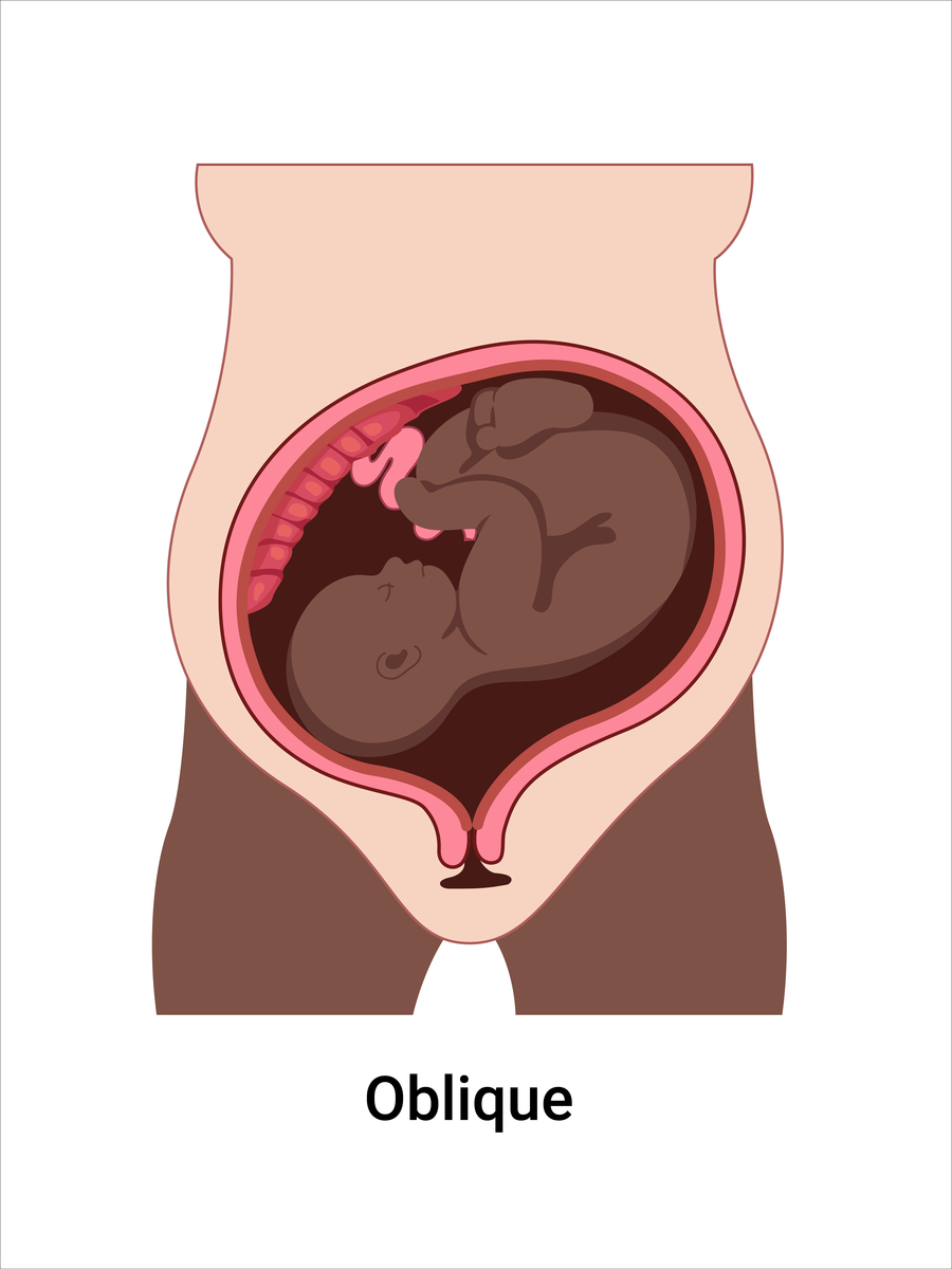 产后出血合并胎膜早破：原因、治疗及预防