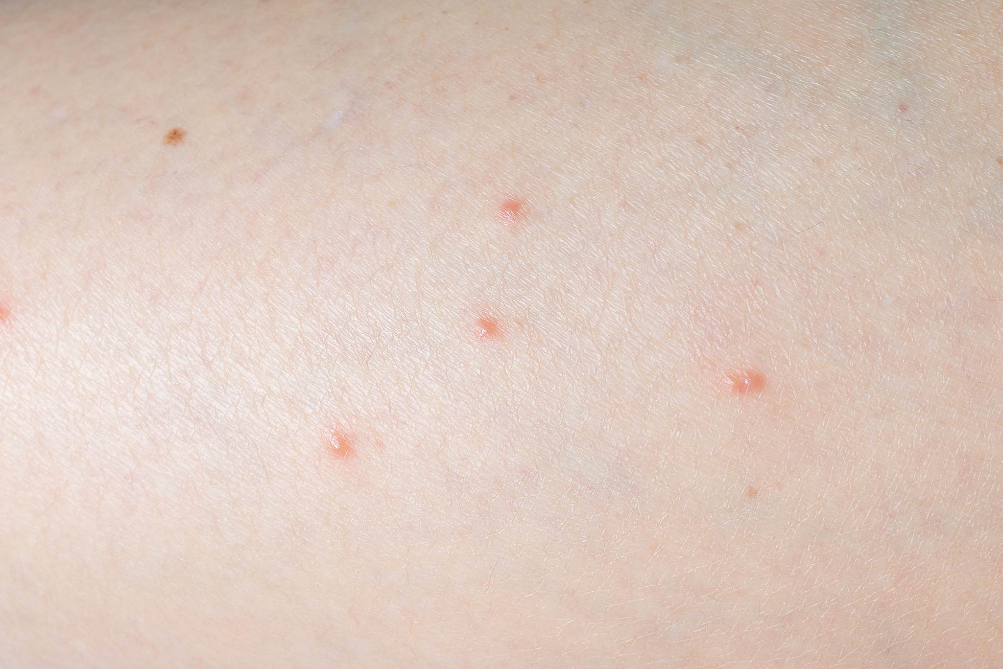 close up of skin been bitten by ticks.