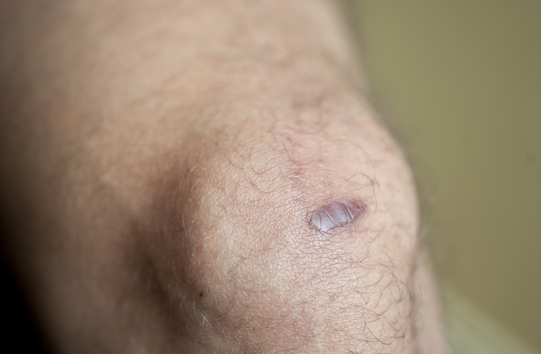 keloid scar