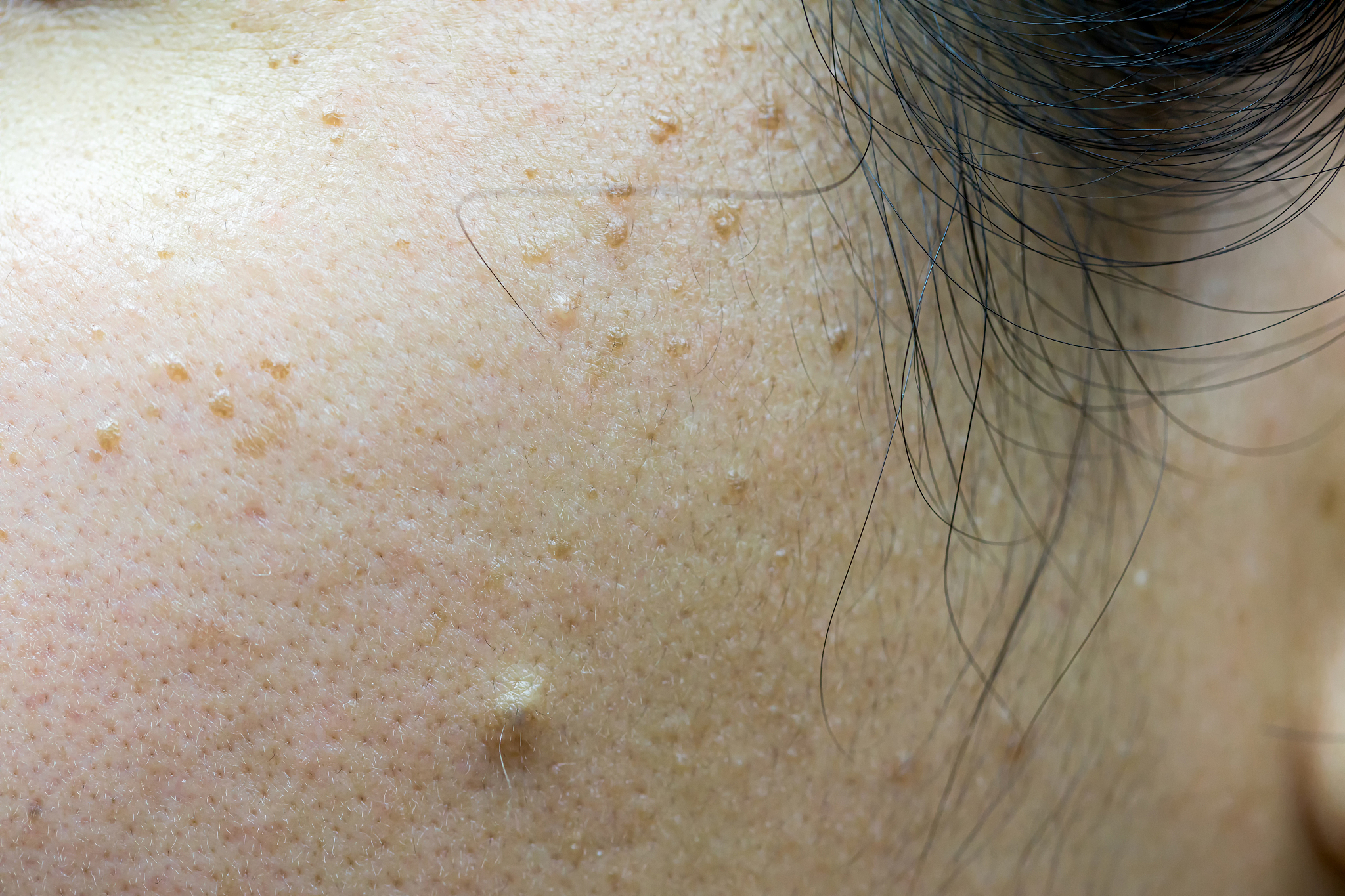 freckles on the face of women caused by sunlight.freckles on asi