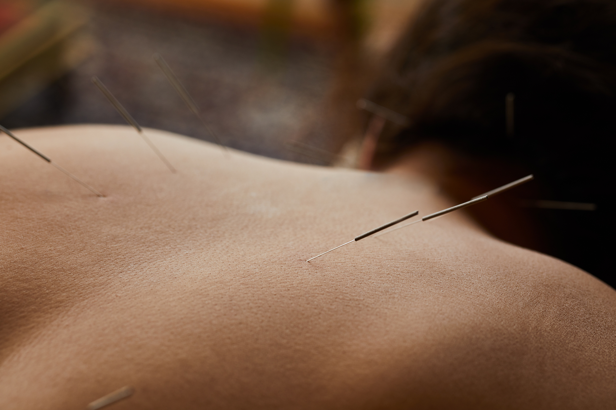 woman getting acupuncture done on her back in a clinic