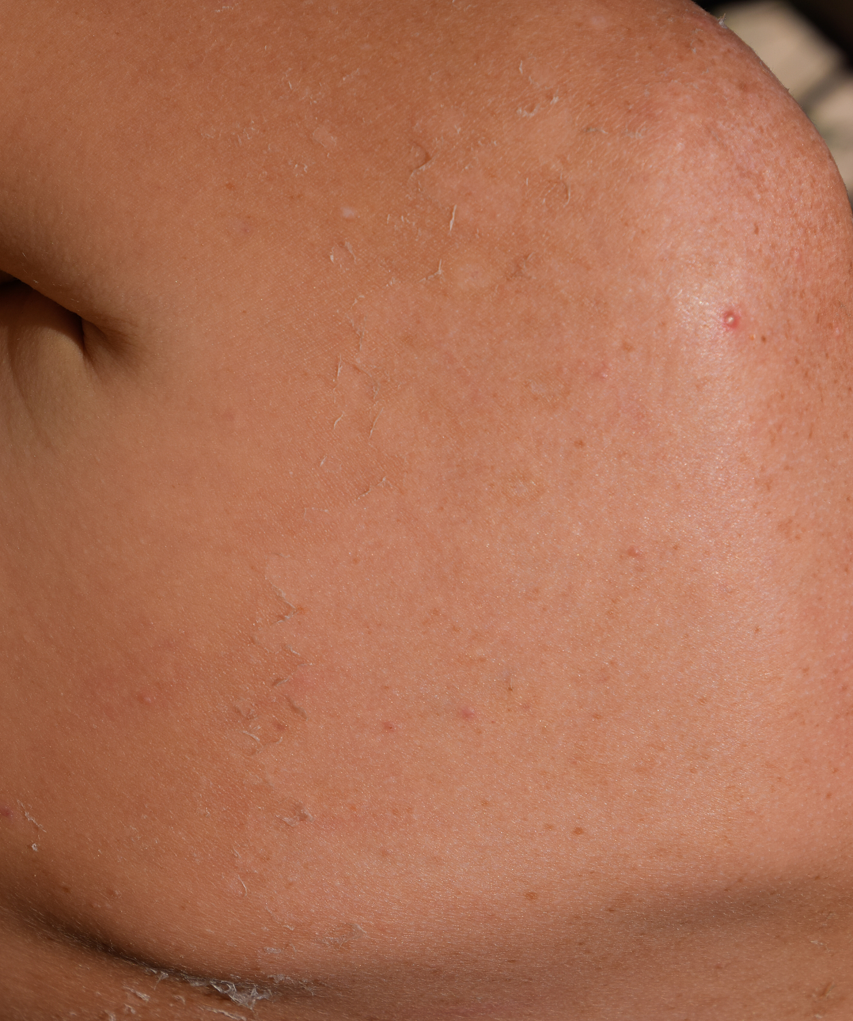 sunburn on the skin of the back. exfoliation, skin peels off. da