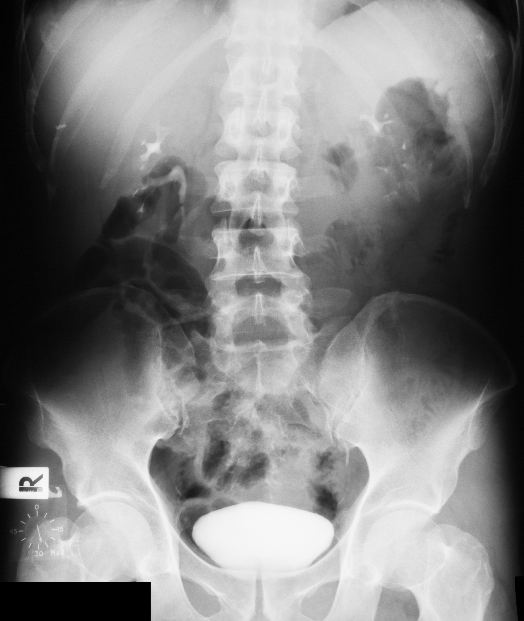 引起尿痛的原因