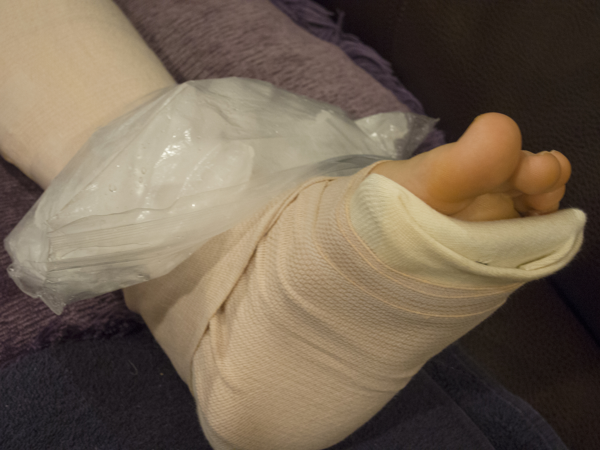 脚踝骨折怎么办？医生详解治疗方法及康复建议