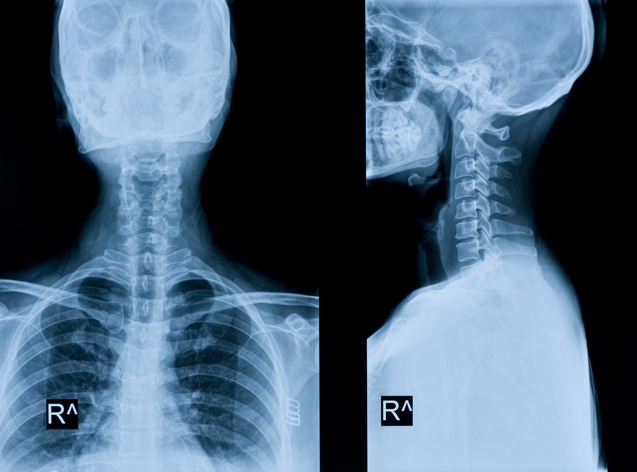 三凹征是什么？哪些部位出现凹陷？