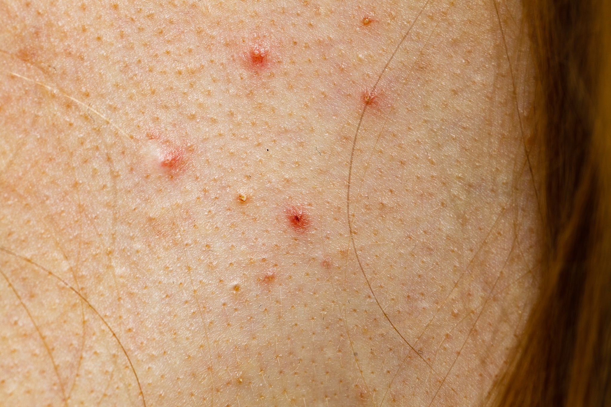 closeup skin with acne moles and red spots.