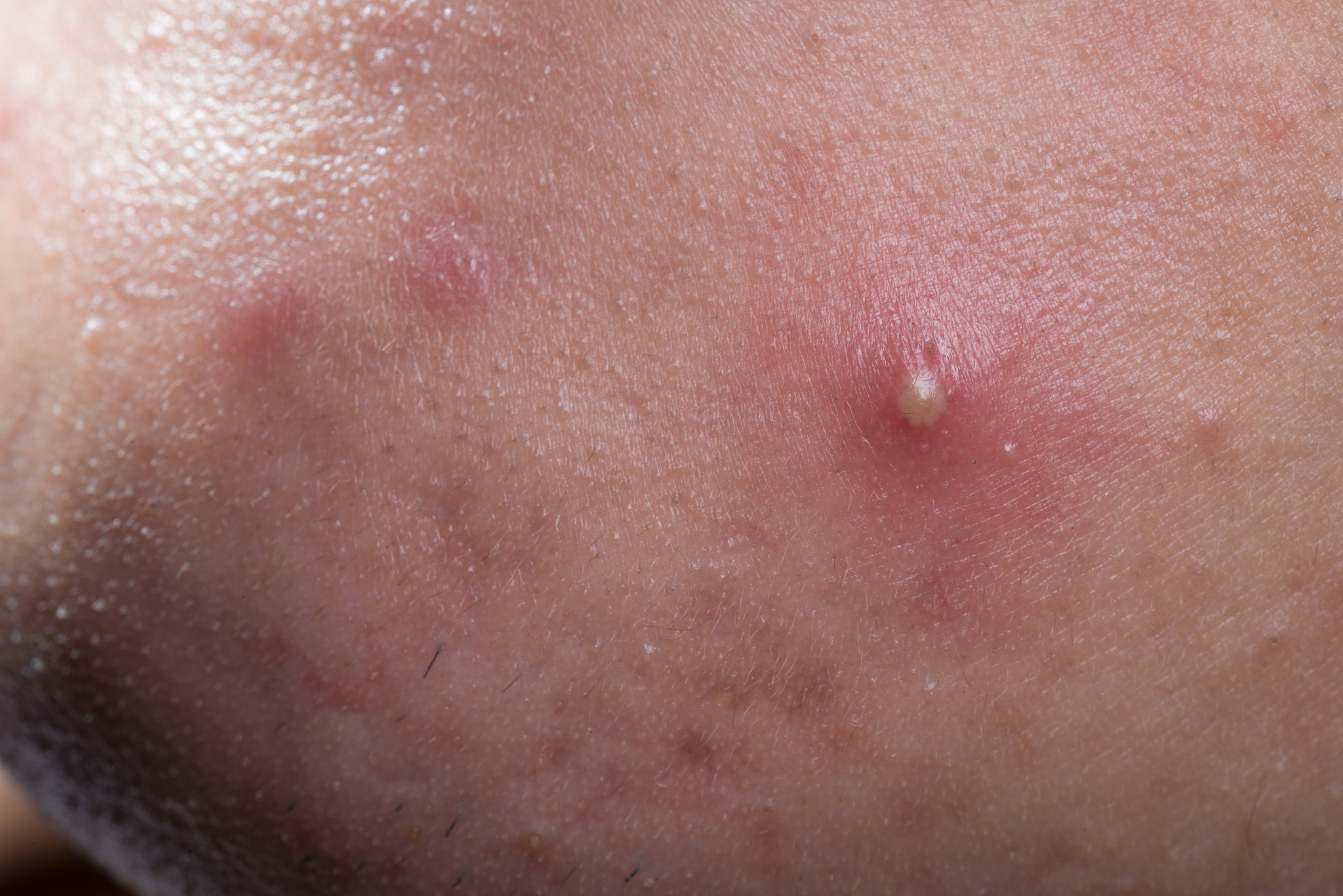 ill skin disease, whelk pimple on face.