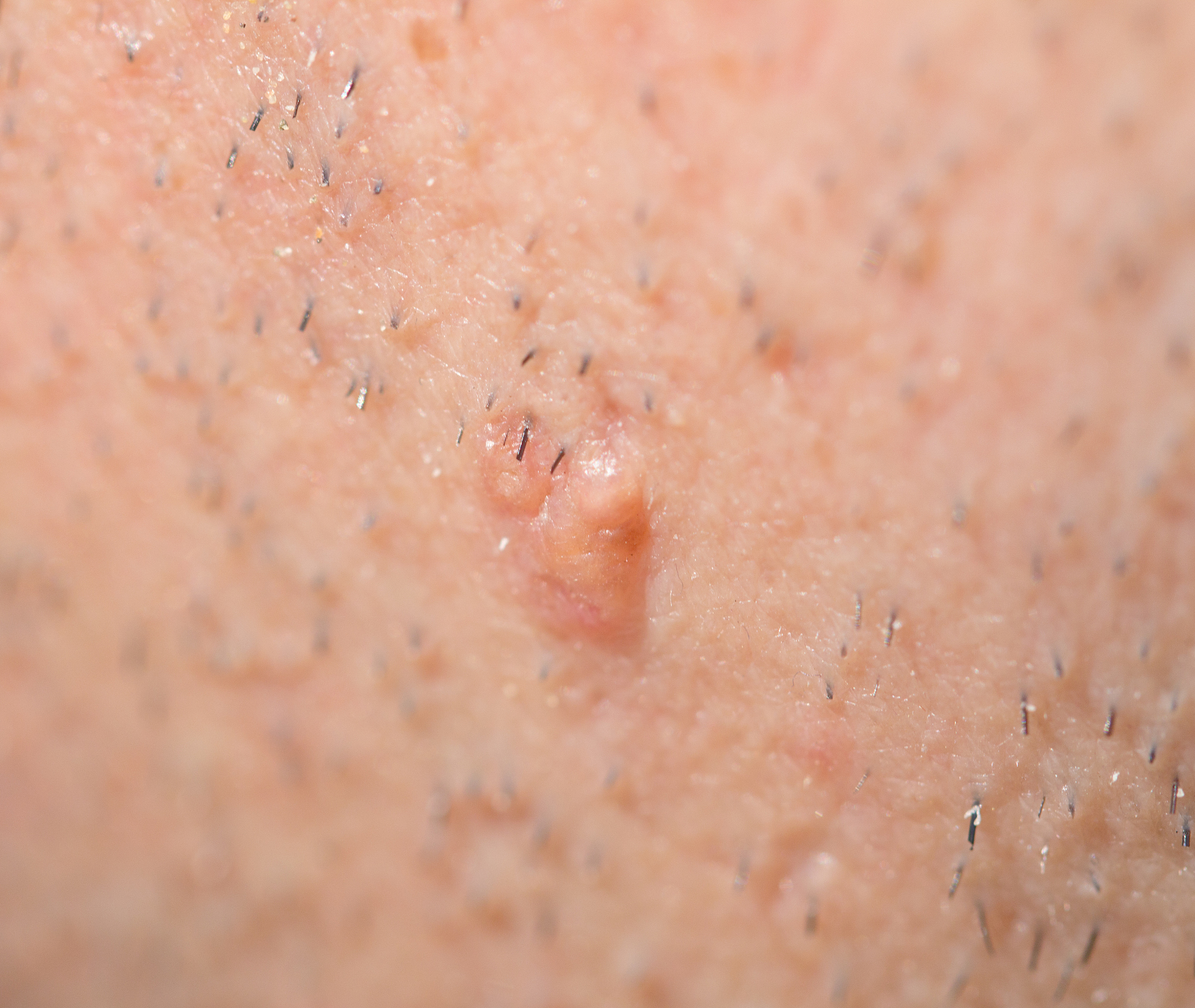 pimple on the skin