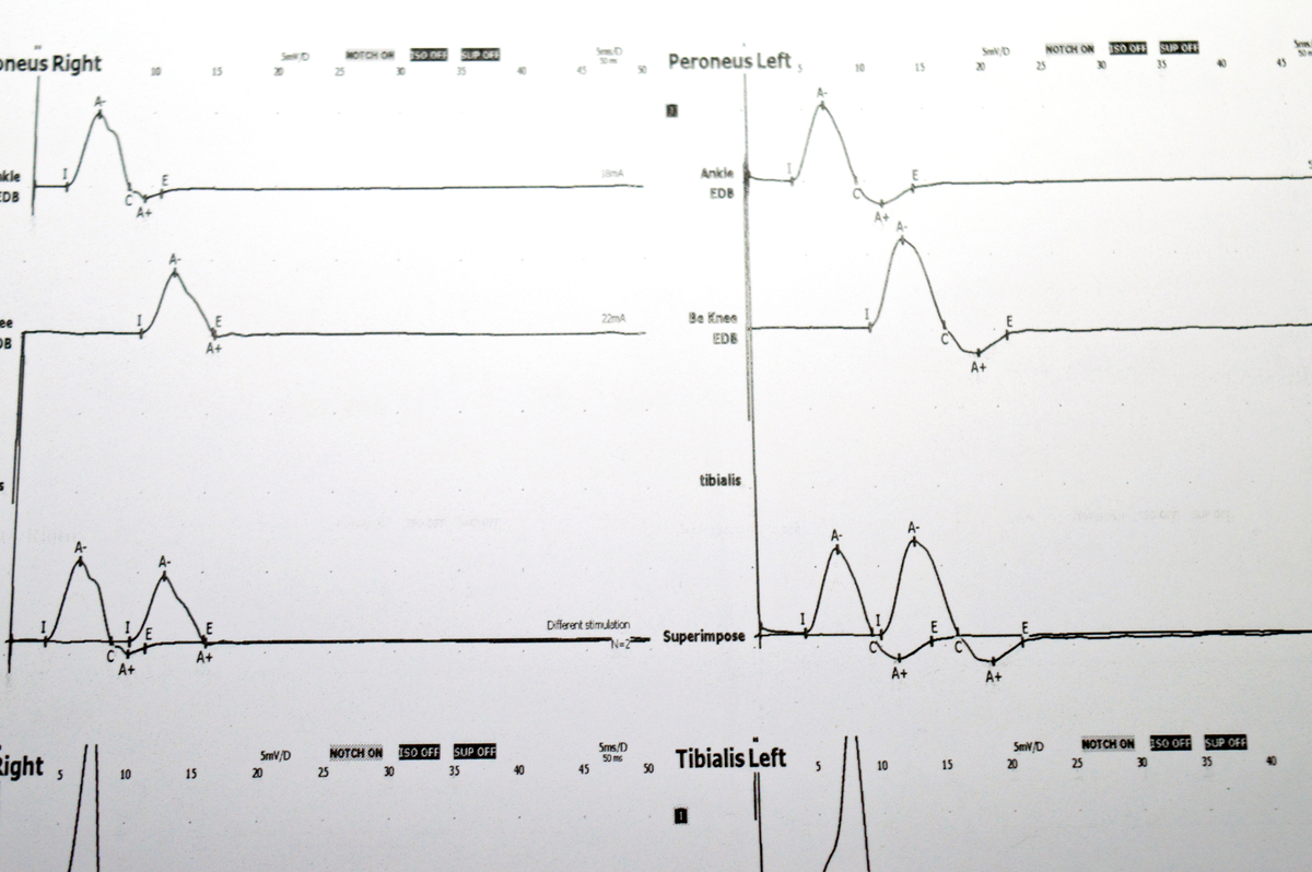 对以下文字进行重写对下面文字进行降重小波变换技术在提升 Q 波检测的准确性方面表现出了良好的性能。根据小波变换理论R 波峰与 模最大模数最小值的零点具有稳定的位移关系。 因此使用小波变换来检测 QRS 波是通过定位 R 波的方法的最大值的模数来检测 R 波从 R 峰值位置开始 选择较小的刻度向前和向后搜索 QRS 波开始和结束以避免 QRS 波的宽度失真。对于干扰严重或非典型 R 波的情况需提炼其