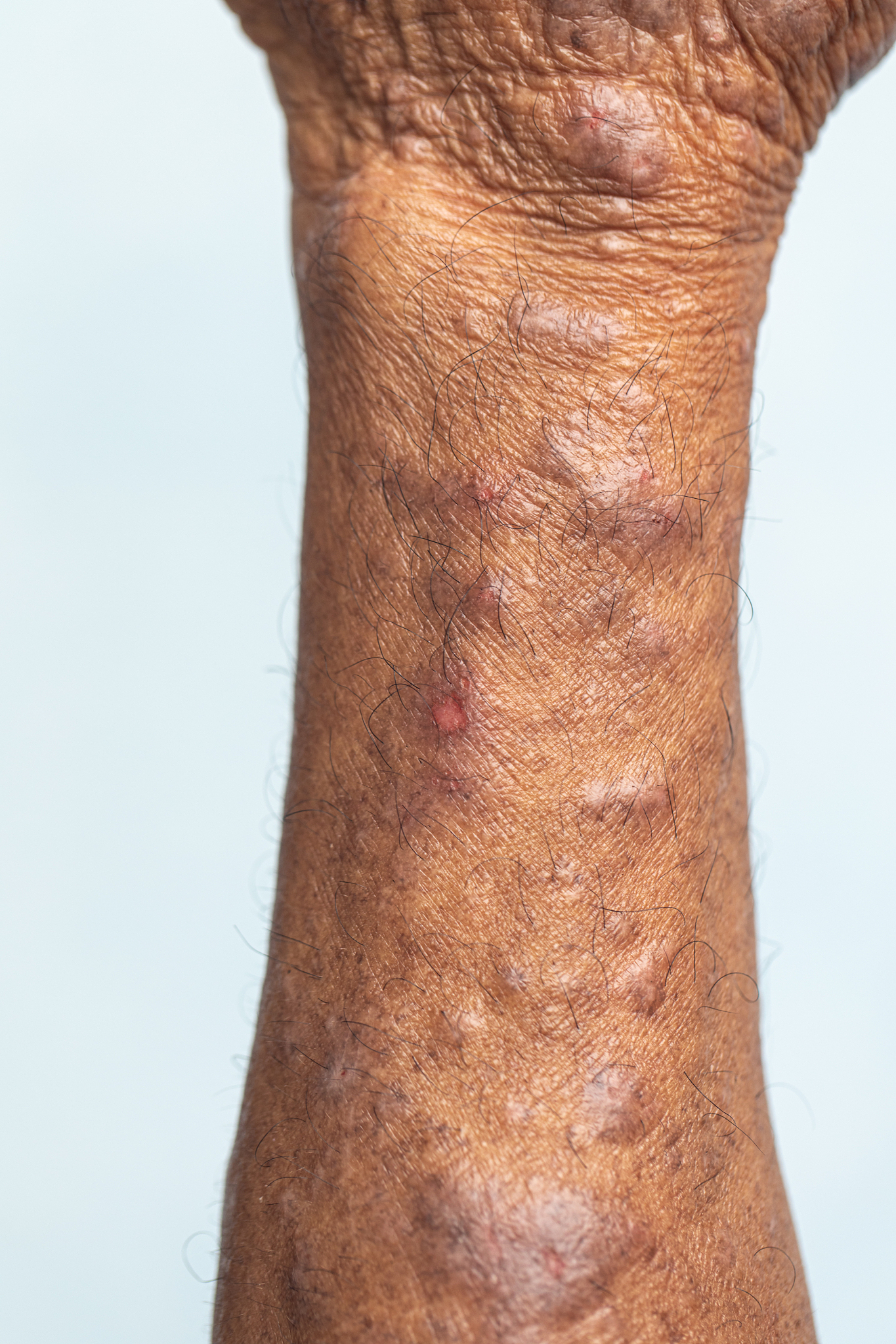 免疫系统失调引发的损美性皮肤病：银屑病、红斑狼疮等