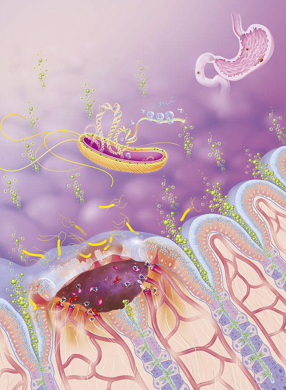 幽门螺旋杆菌：少碰‘2水3红’！4步修复胃黏膜
