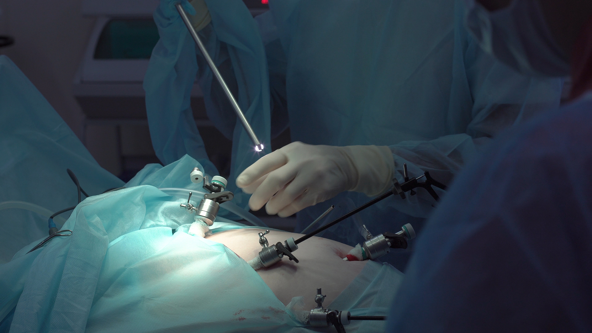 operation using laparoscopic equipment. surgeons team. hospital